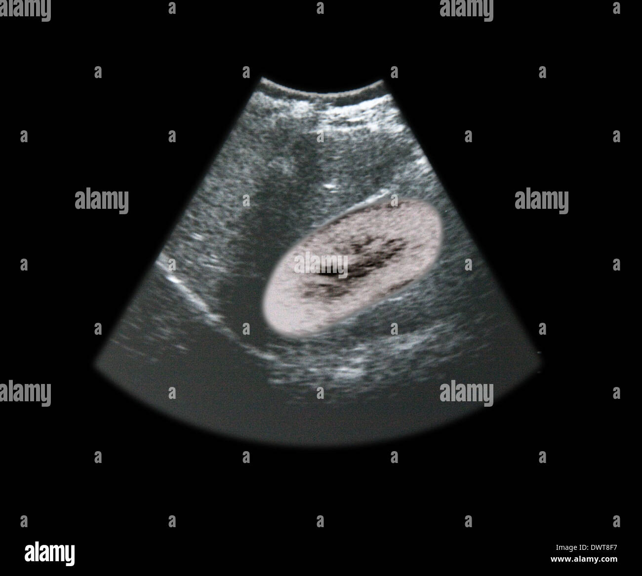 Kidney ultrasound scan Stock Photo Alamy