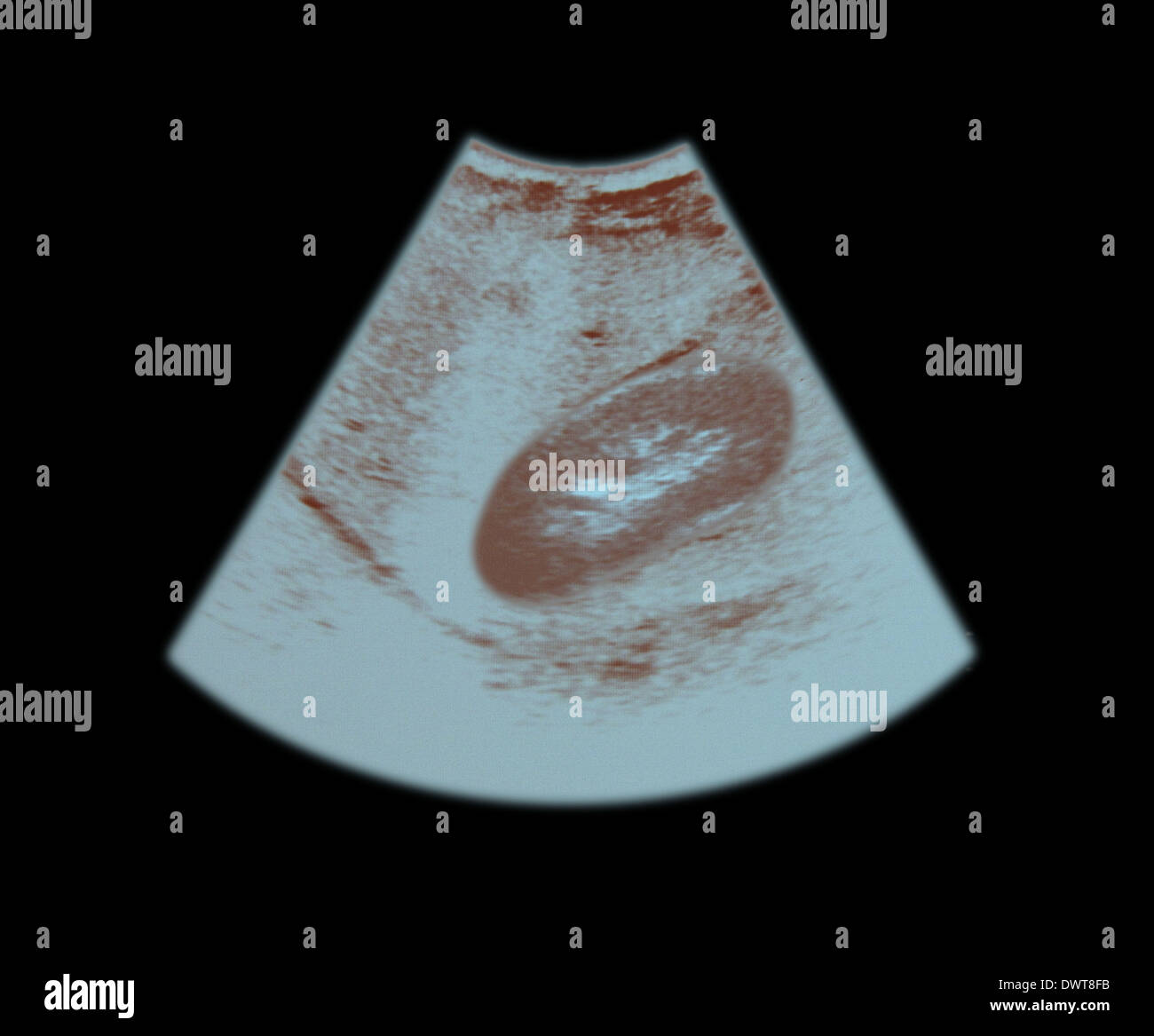 Kidney ultrasound scan Stock Photo