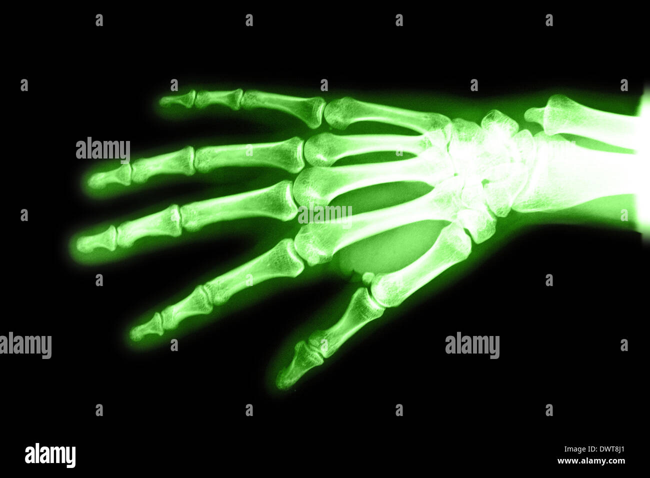 Hand x ray Stock Photo Alamy