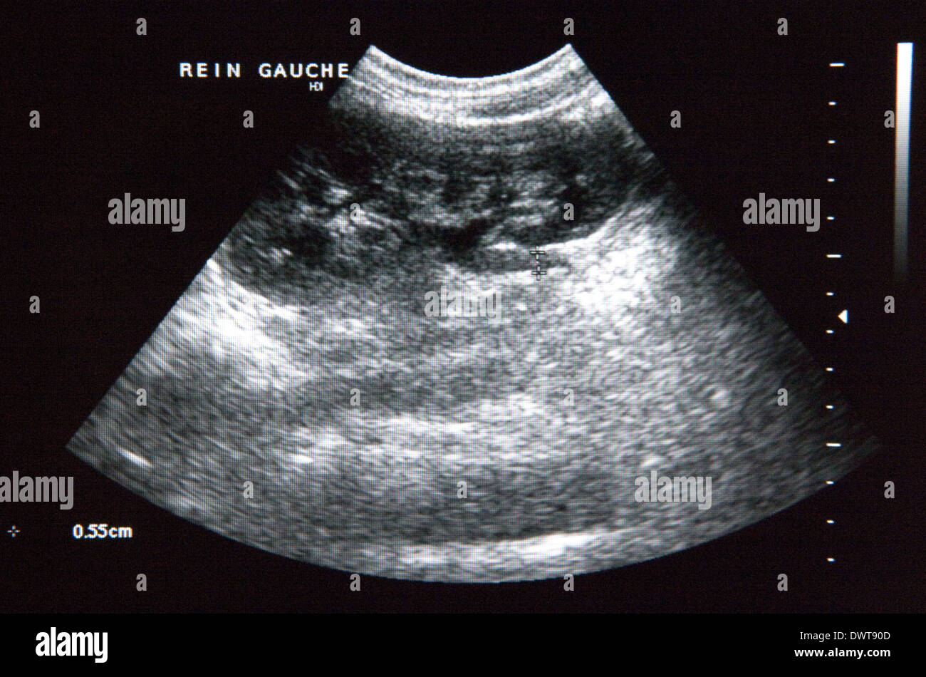 Kidney ultrasound scan Stock Photo - Alamy