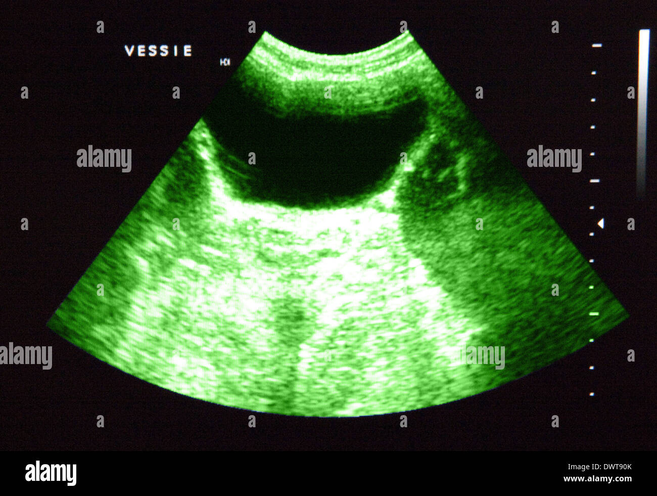 Bladder Ultrasound Scan Stock Photo Alamy   Bladder Ultrasound Scan DWT90K 