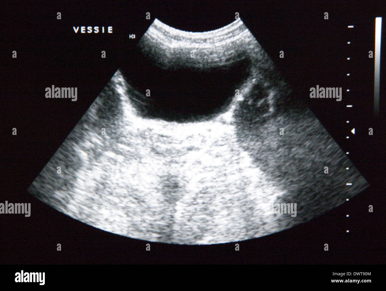 Bladder ultrasound scan Stock Photo Alamy