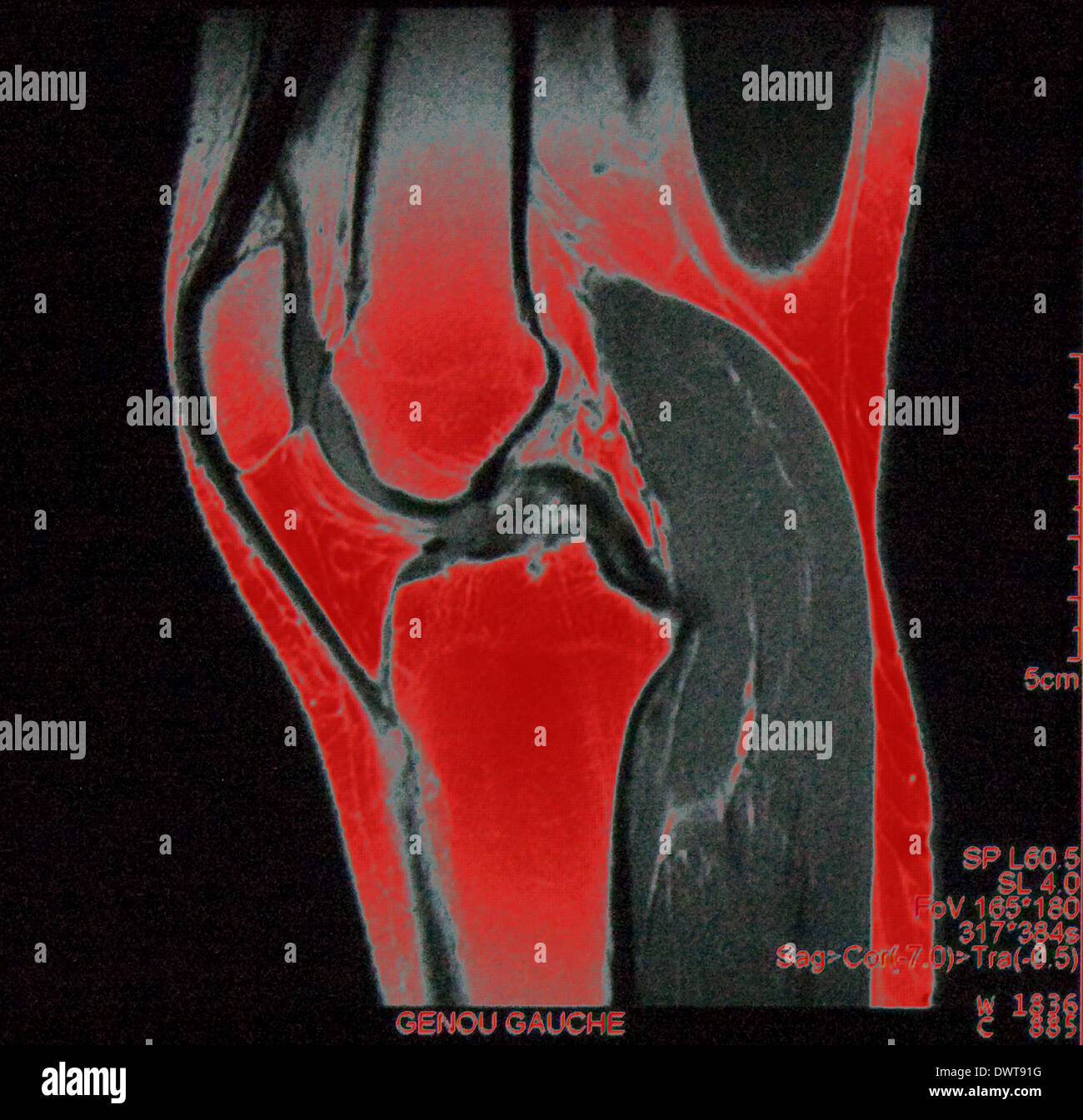 Knee ligament mri hi-res stock photography and images - Alamy