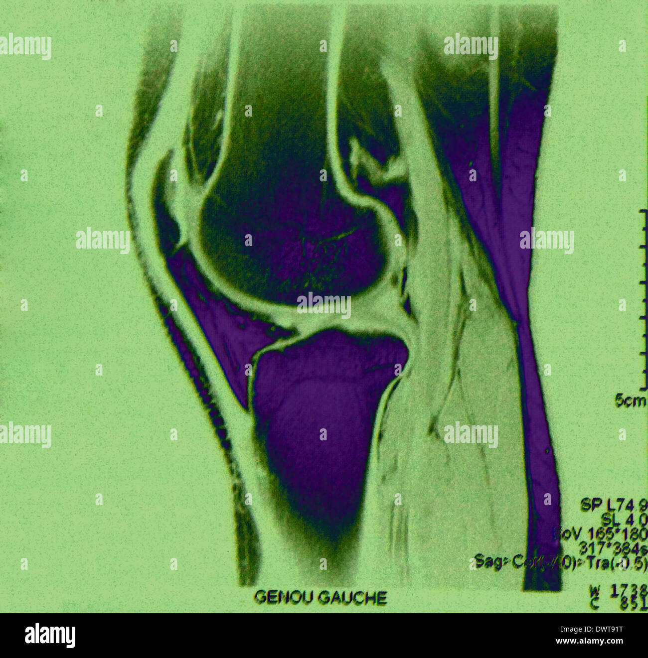 External meniscus hires stock photography and images Alamy