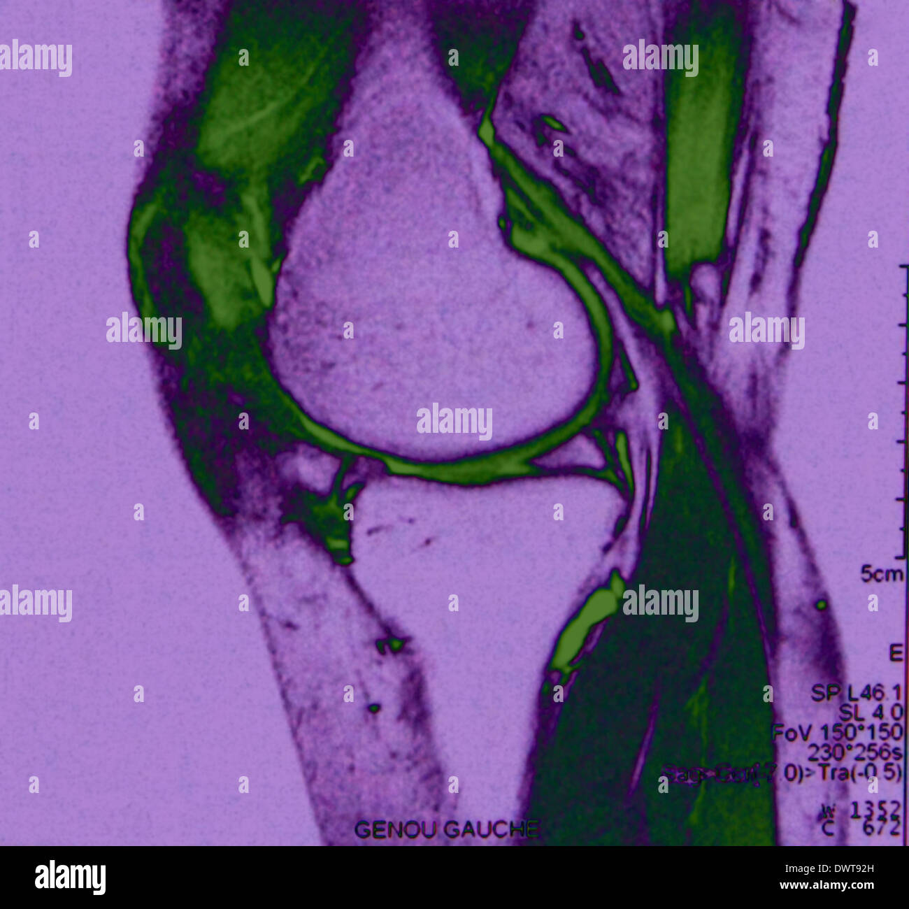 Lower limb mri hires stock photography and images Alamy