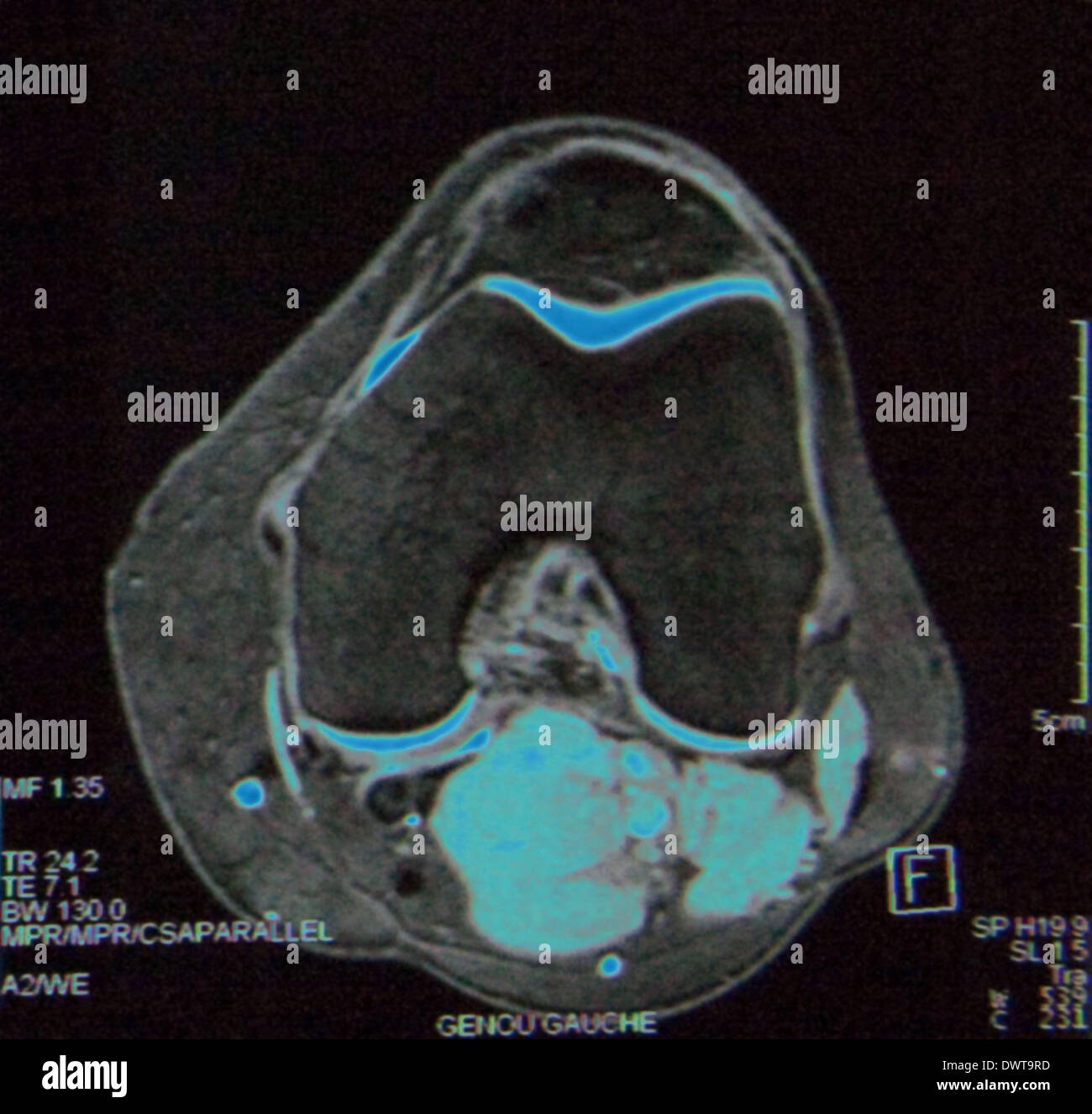 Knee mri Stock Photo