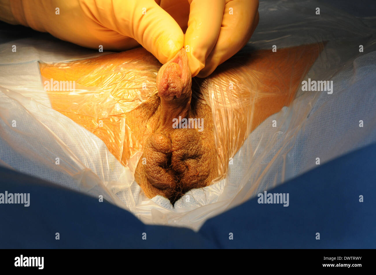 Metaidoioplastik 💉 Metoidioplastie: