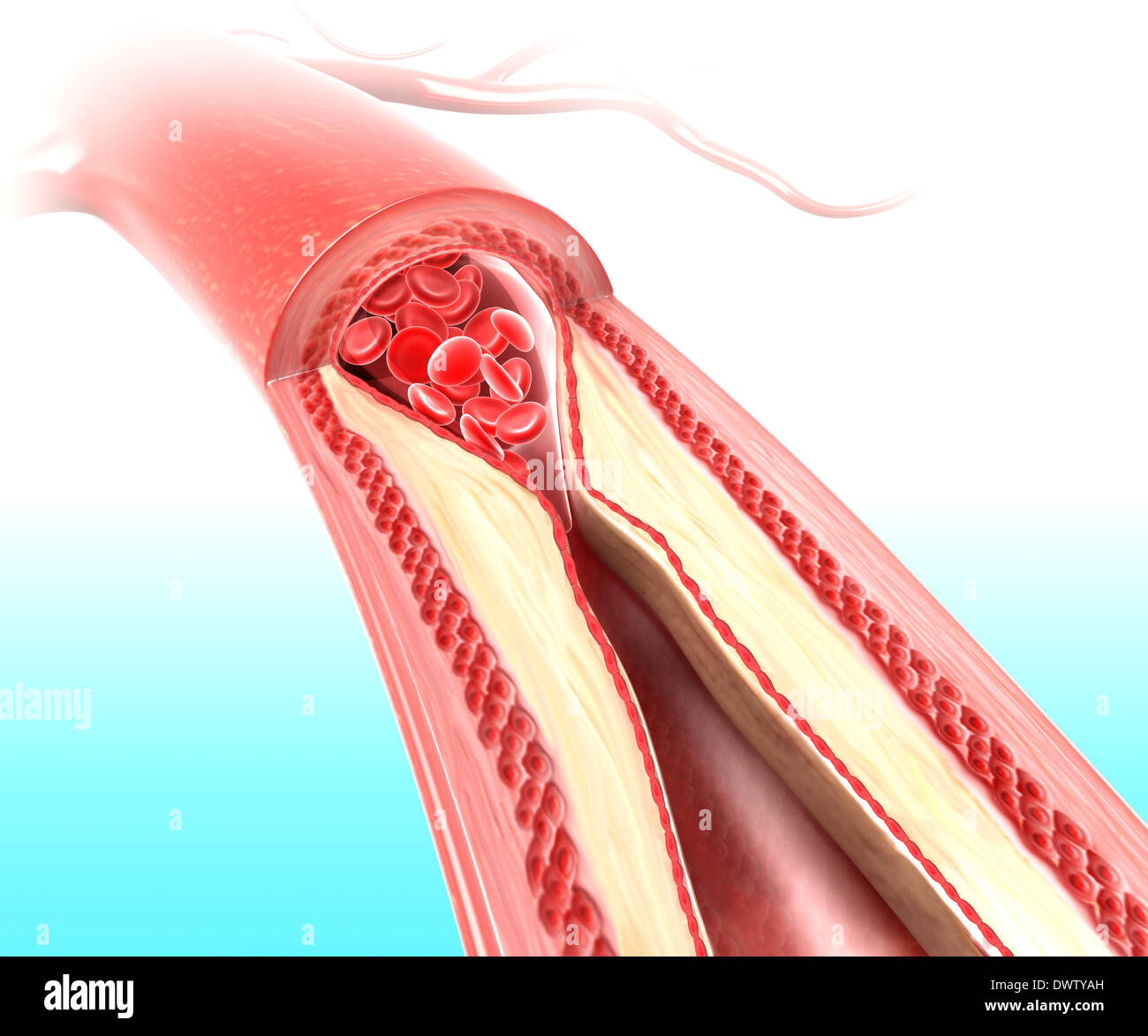 Arteriosclerosis drawing Stock Photo
