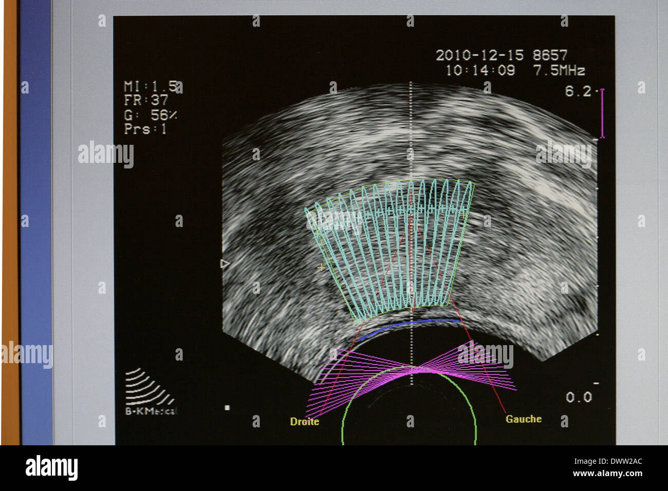 Cancer prostate ablatherm Stock Photo - Alamy