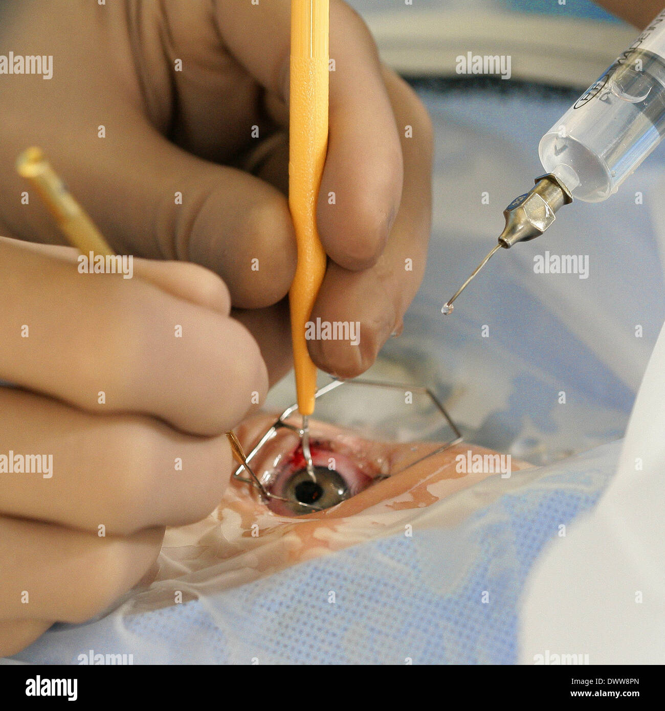 Surgery strabismus Stock Photo