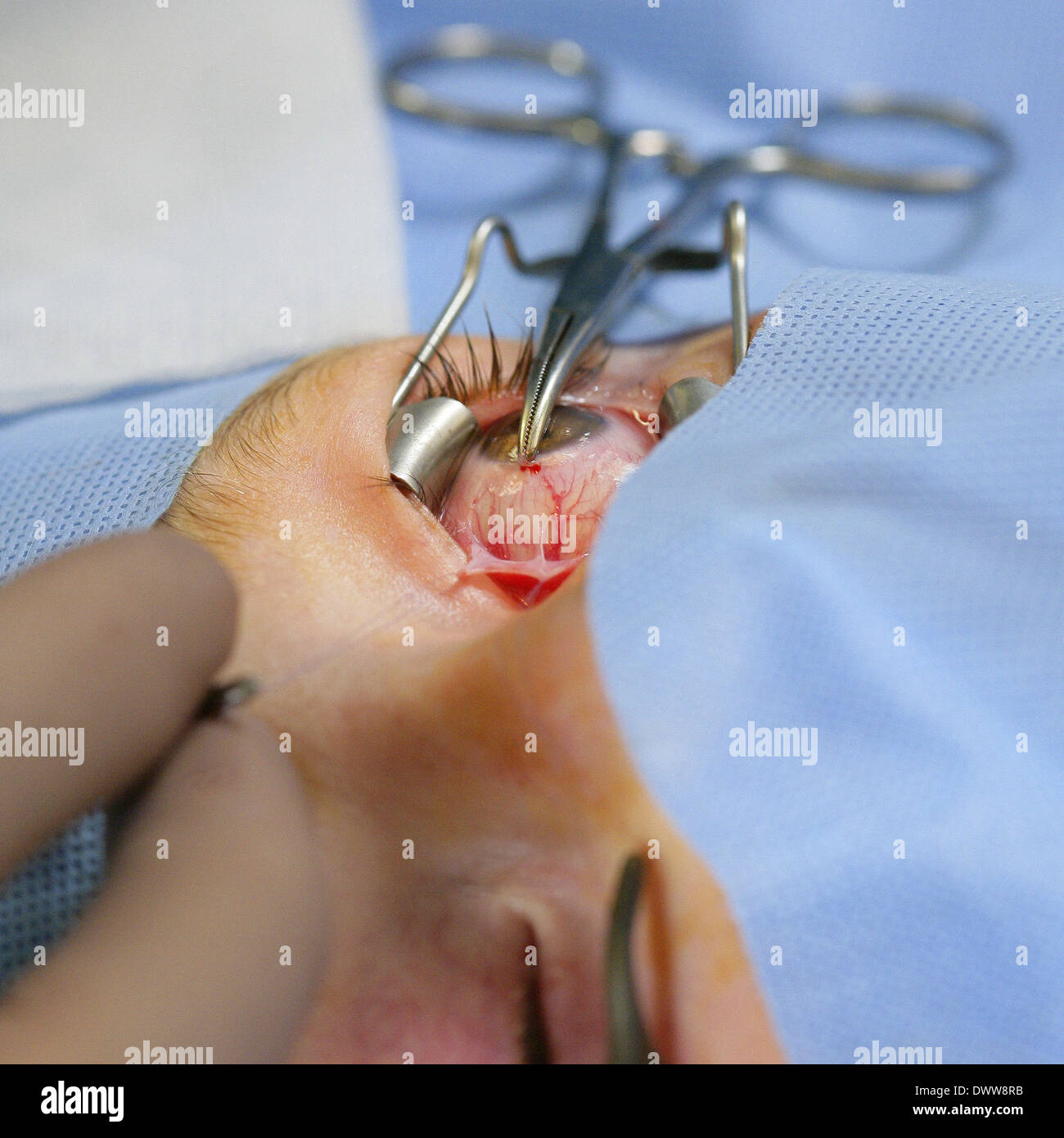Surgery strabismus Stock Photo
