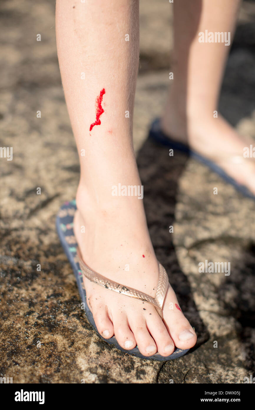 Low section of girl with wounded leg standing on rock Stock Photo