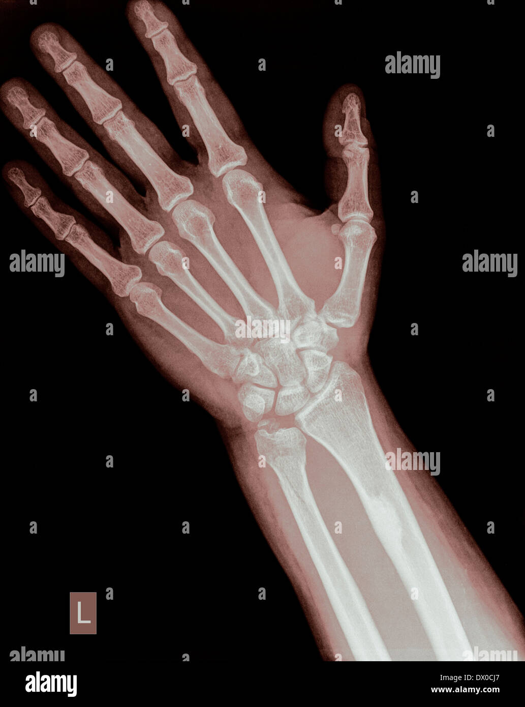Clinical photograph of the right wrist of a 35-yearold male