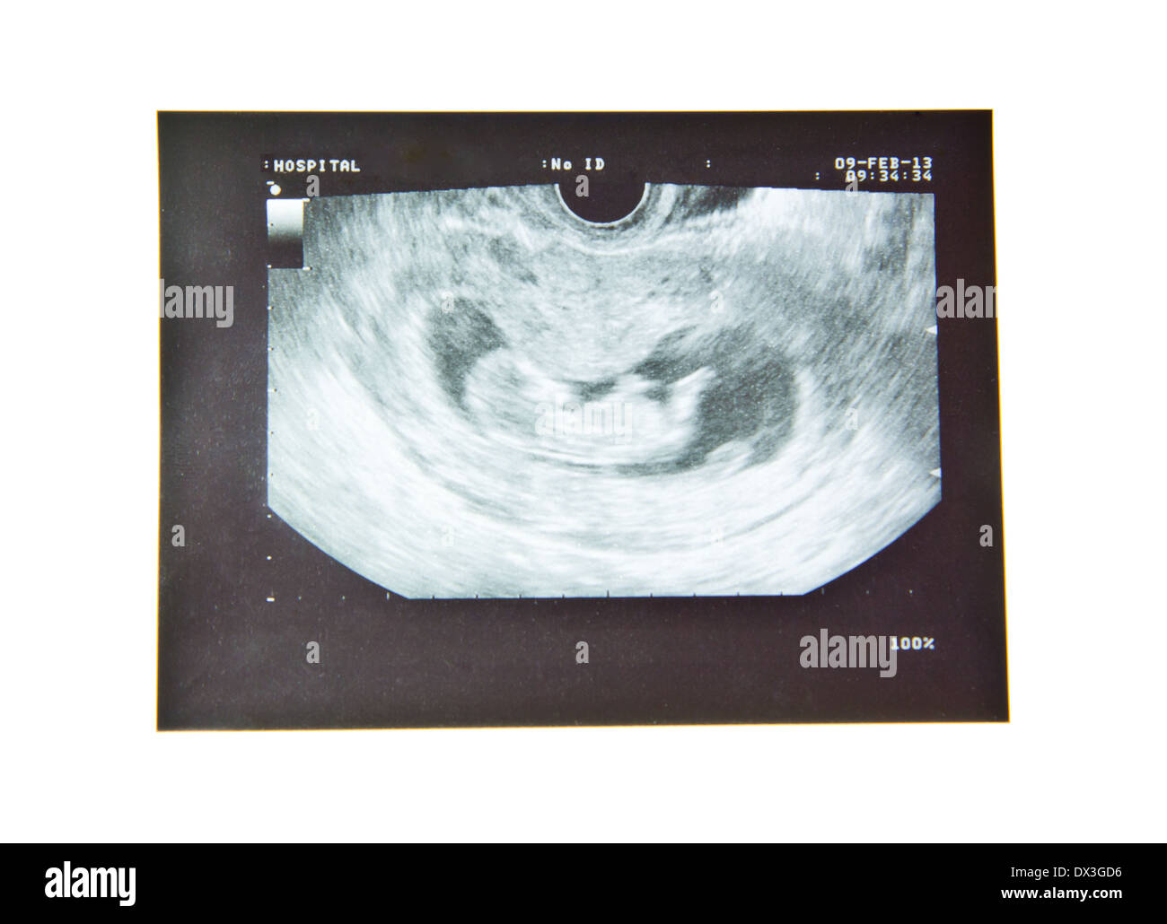 12 Weeks Fetus High Resolution Stock Photography And Images Alamy
