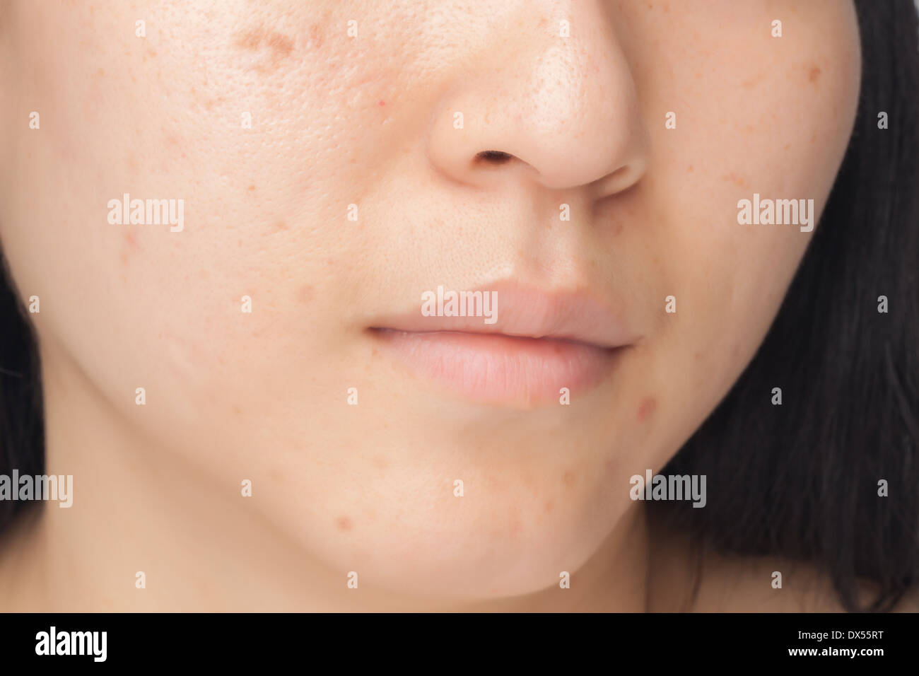 oily skin acne scars