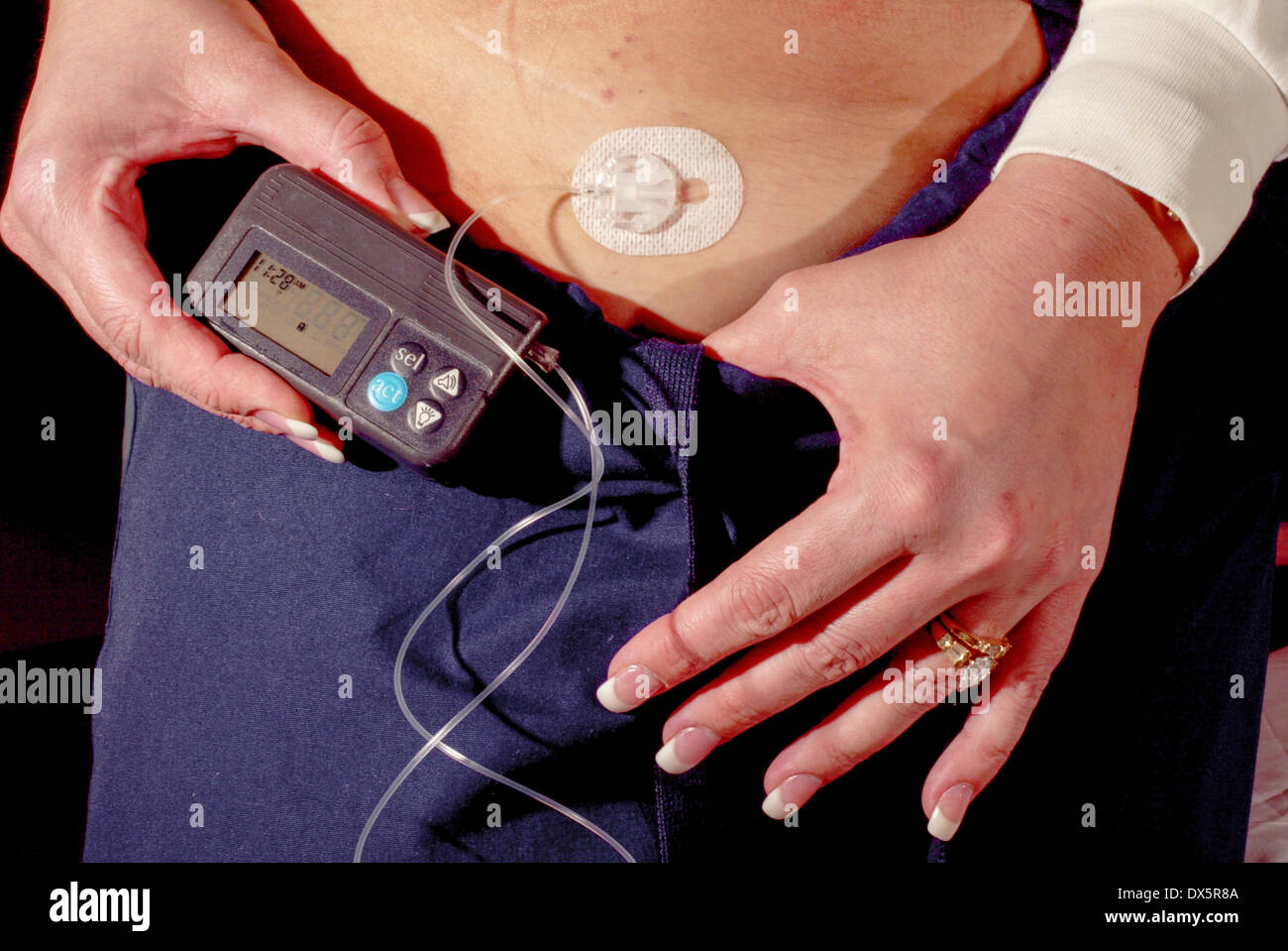 An electronic insulin pump is a medical device used for the administration  of insulin in the treatment of diabetes mellitus, also known as continuous  subcutaneous insulin infusion therapy Stock Photo - Alamy