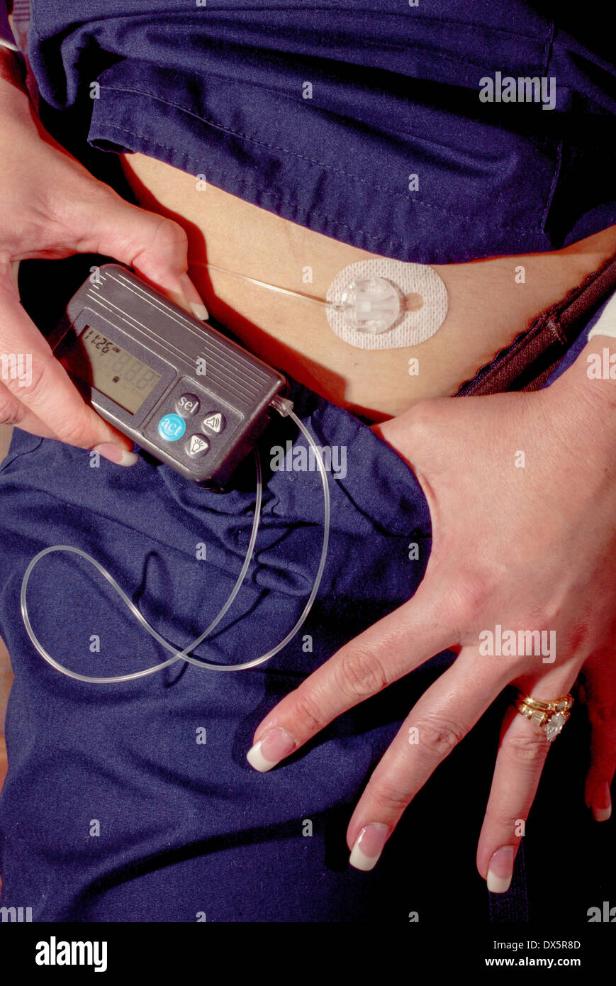 An electronic insulin pump is a medical device used for the