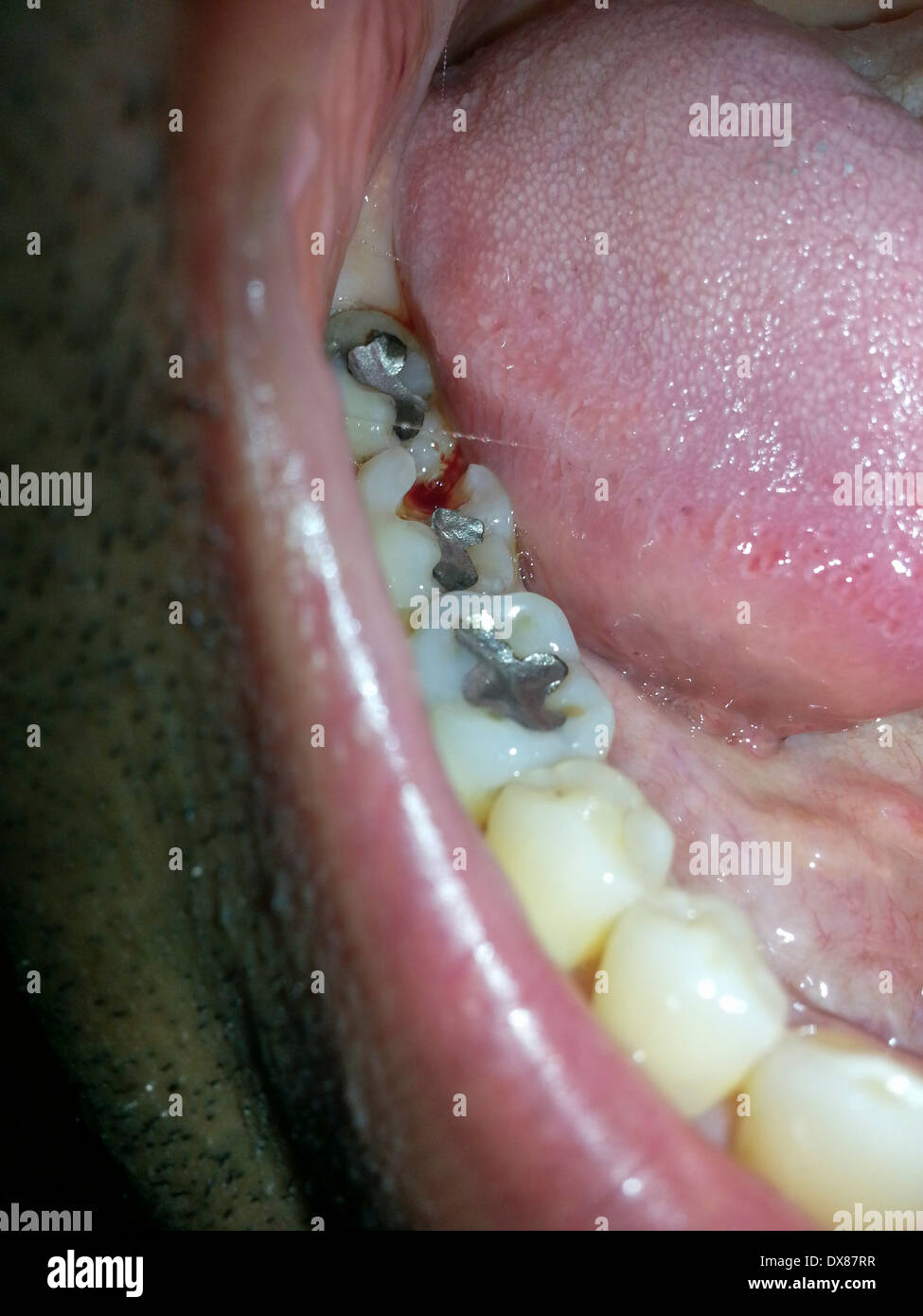 Closeup of a dental cavity Stock Photo Alamy