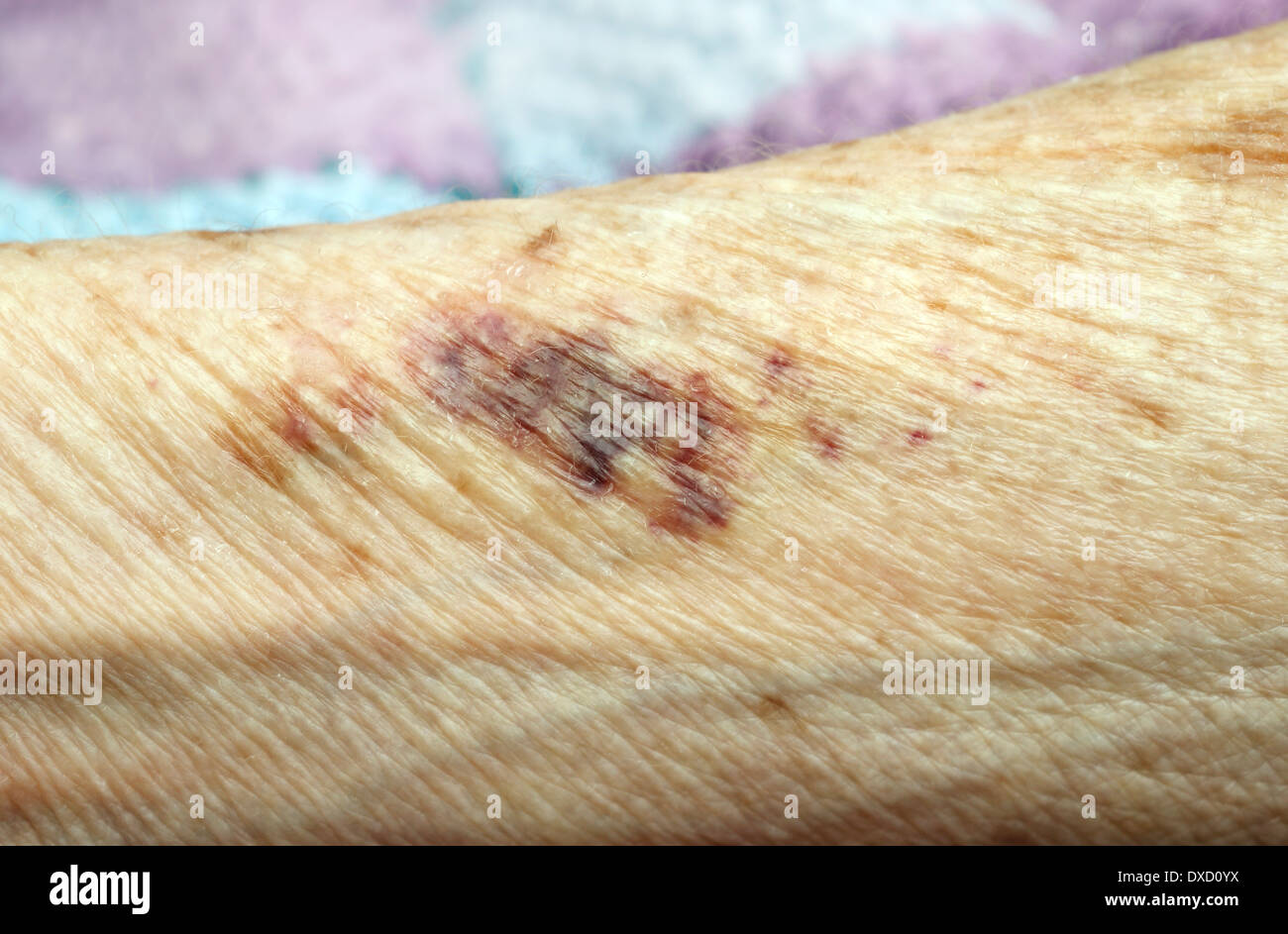 Woman bruising arm hi-res stock photography and images - Alamy
