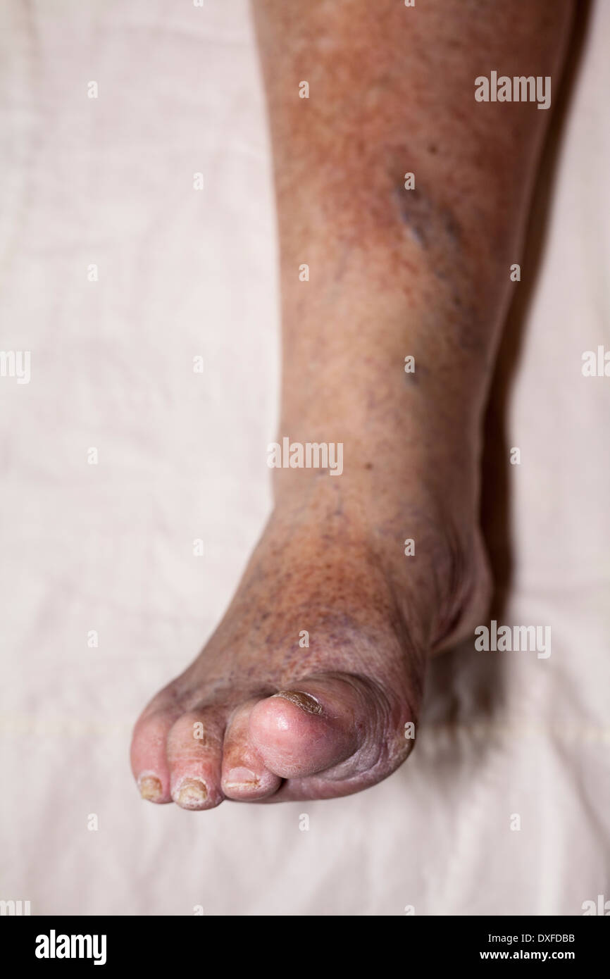 Detail of ill senior female swollen leg with damaged toes and nails ...