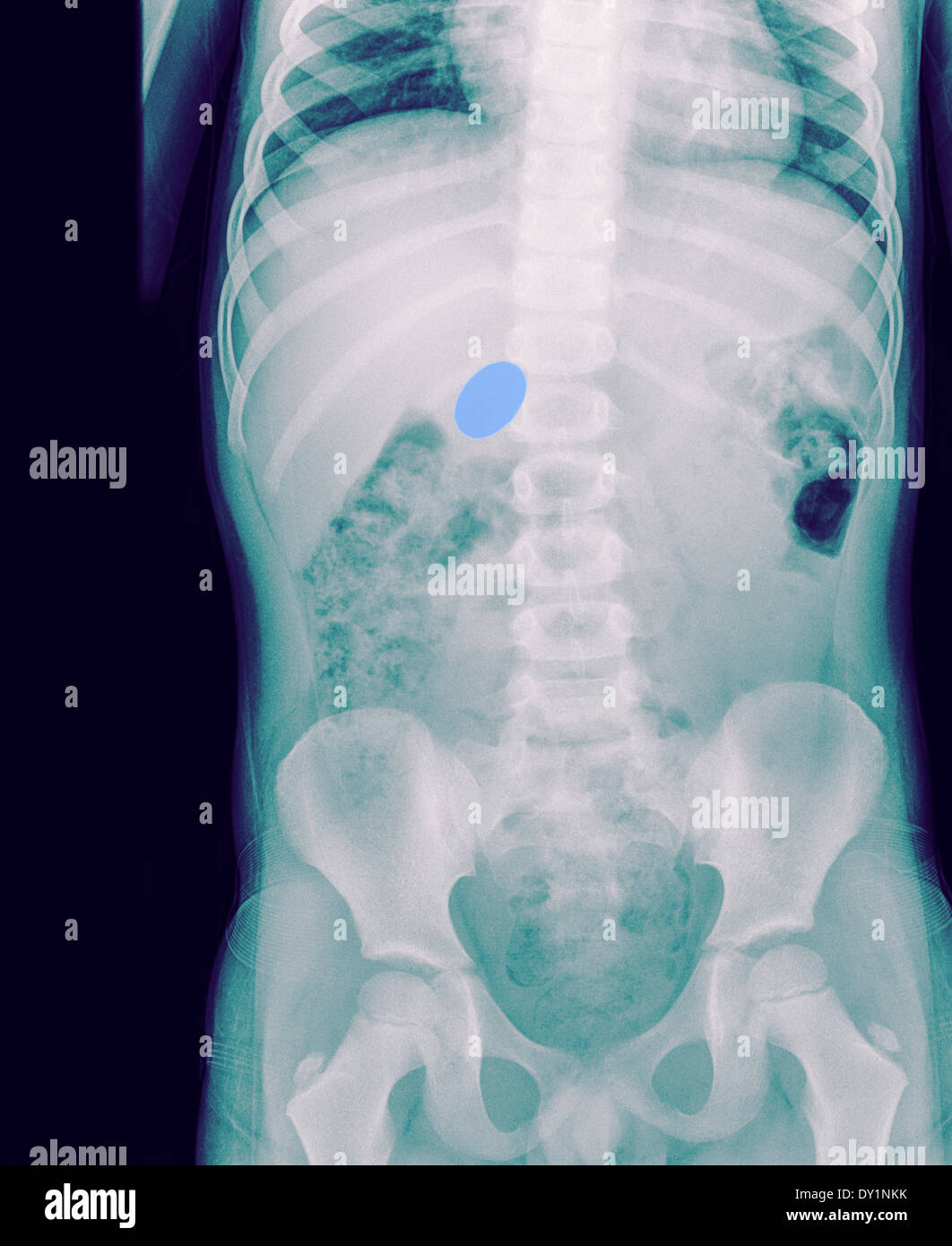 Child swallowed coin hires stock photography and images Alamy