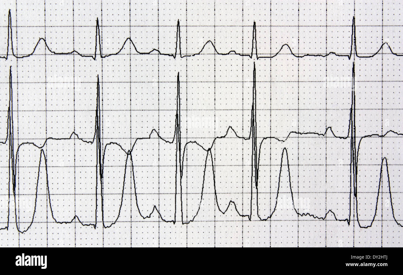 Detail of an electrocardiogram in paper heart rhythm disease cardiology ...