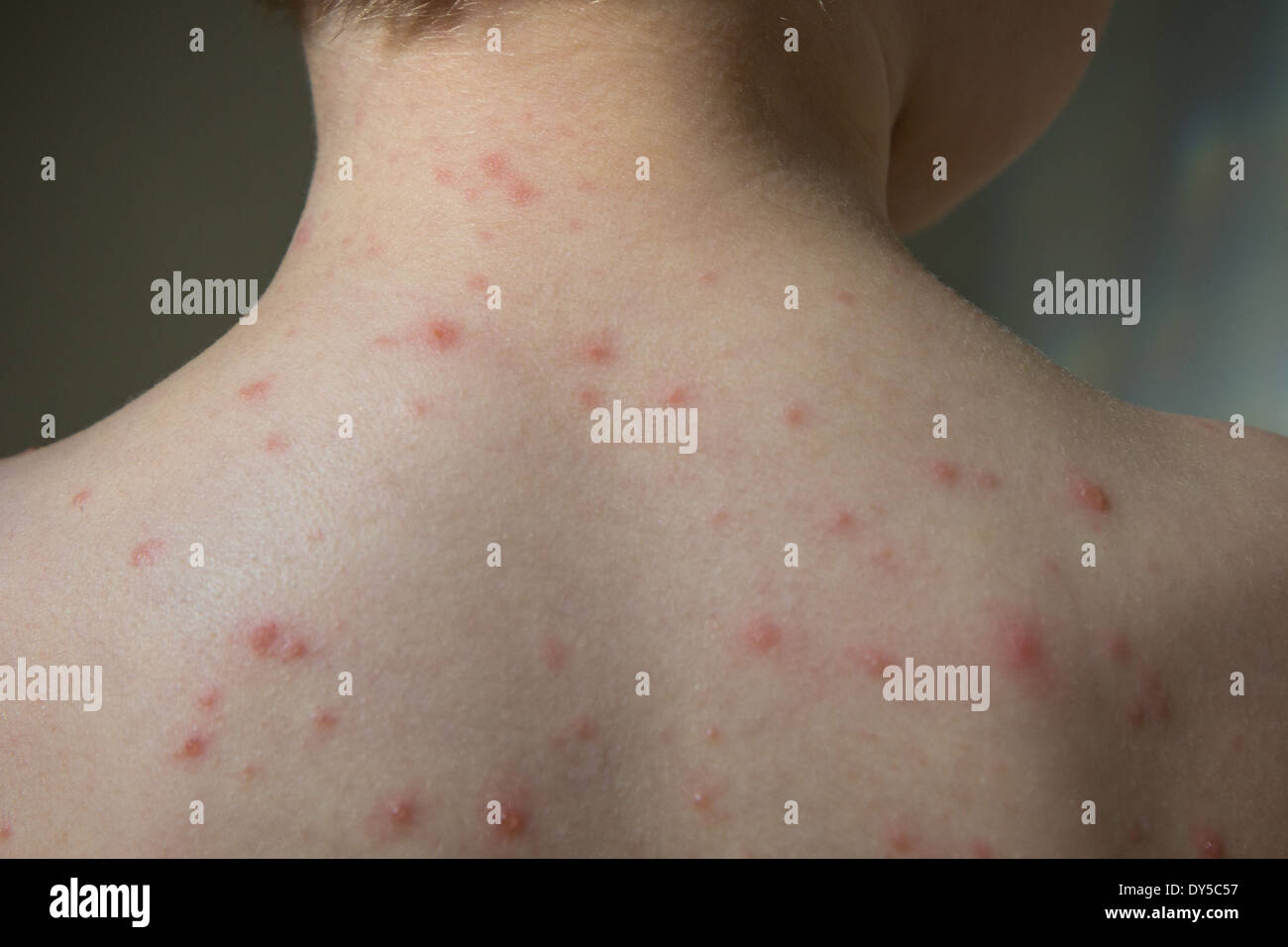 Chicken pox hi-res stock photography and images - Alamy