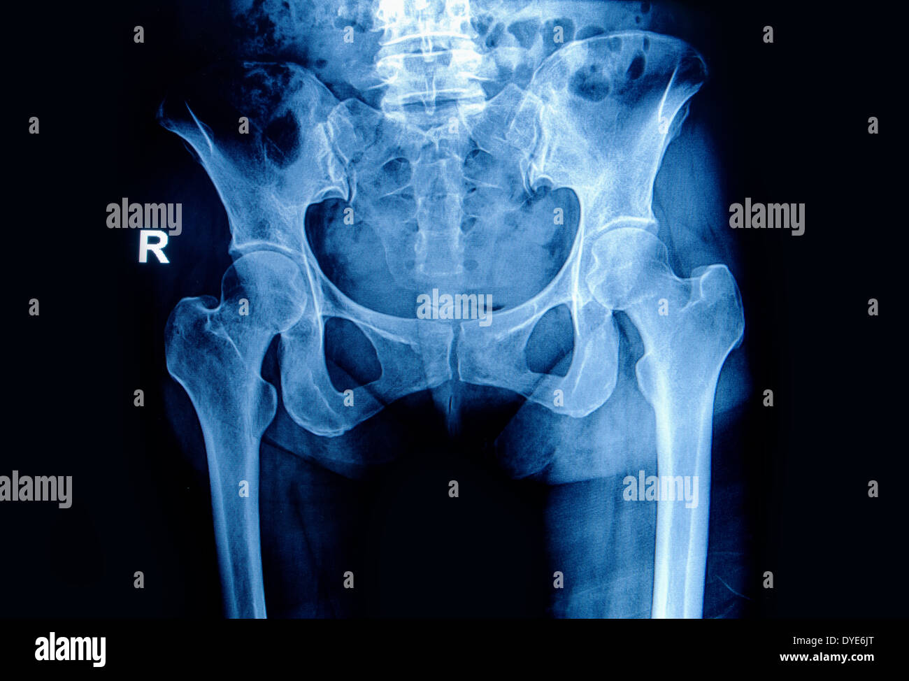 Pelvis Radiology High Resolution Stock Photography And Images Alamy