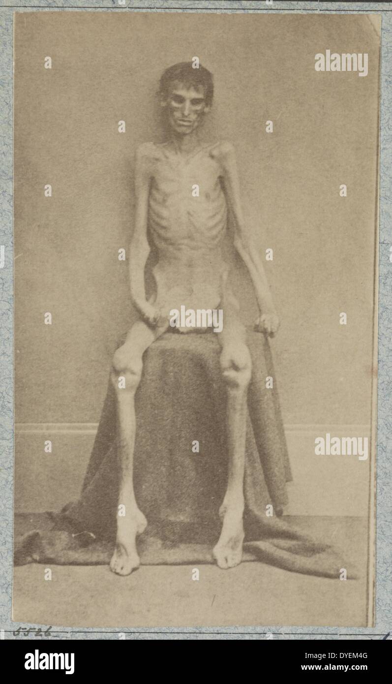 Returned Federal prisoner from Andersonville (i.e. Belle Isle) prison [photographed 1864]. photo shows a prisoner of war at the U.S. General Hospital, Div. 1, Annapolis, Maryland. Photograph taken by surgeon A. Hill Messinger. Stock Photo