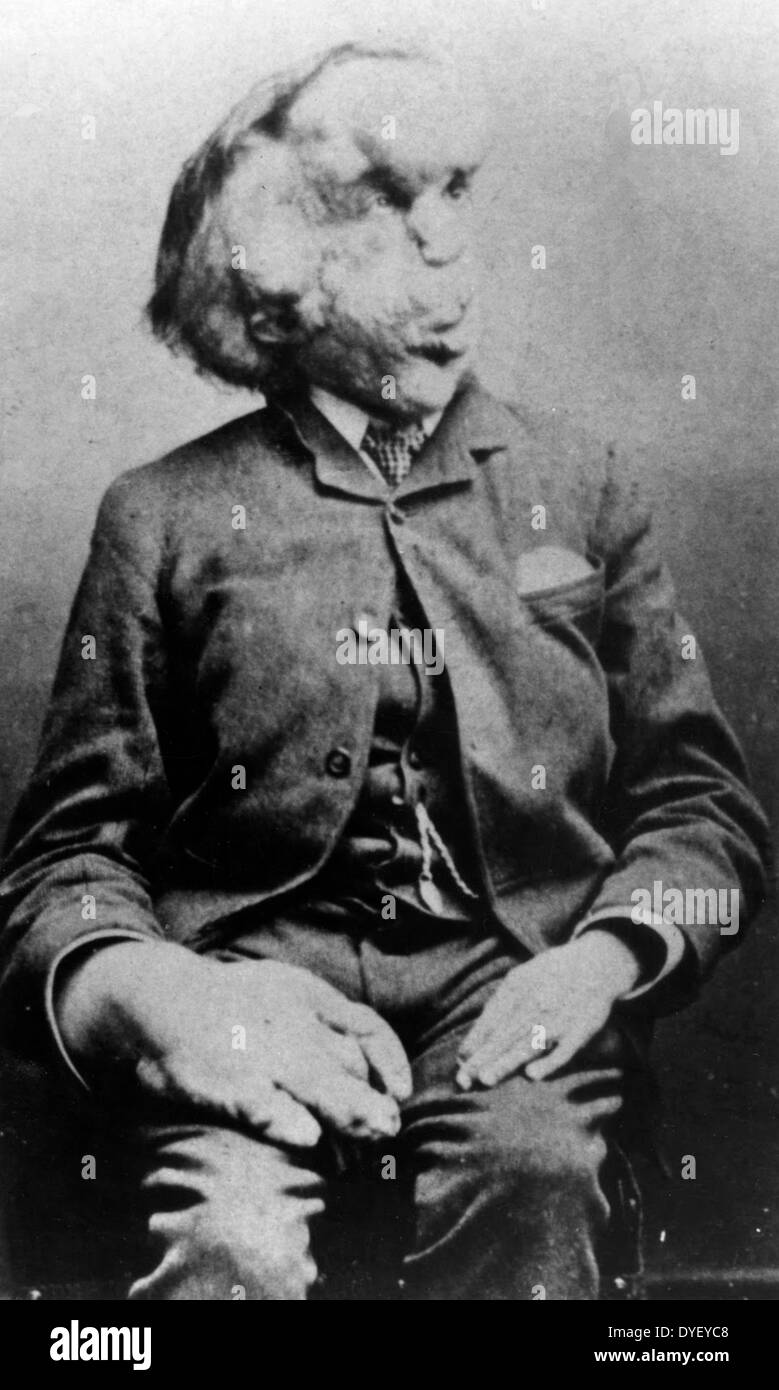 Joseph Merrick Stock Photos & Joseph Merrick Stock Images Alamy