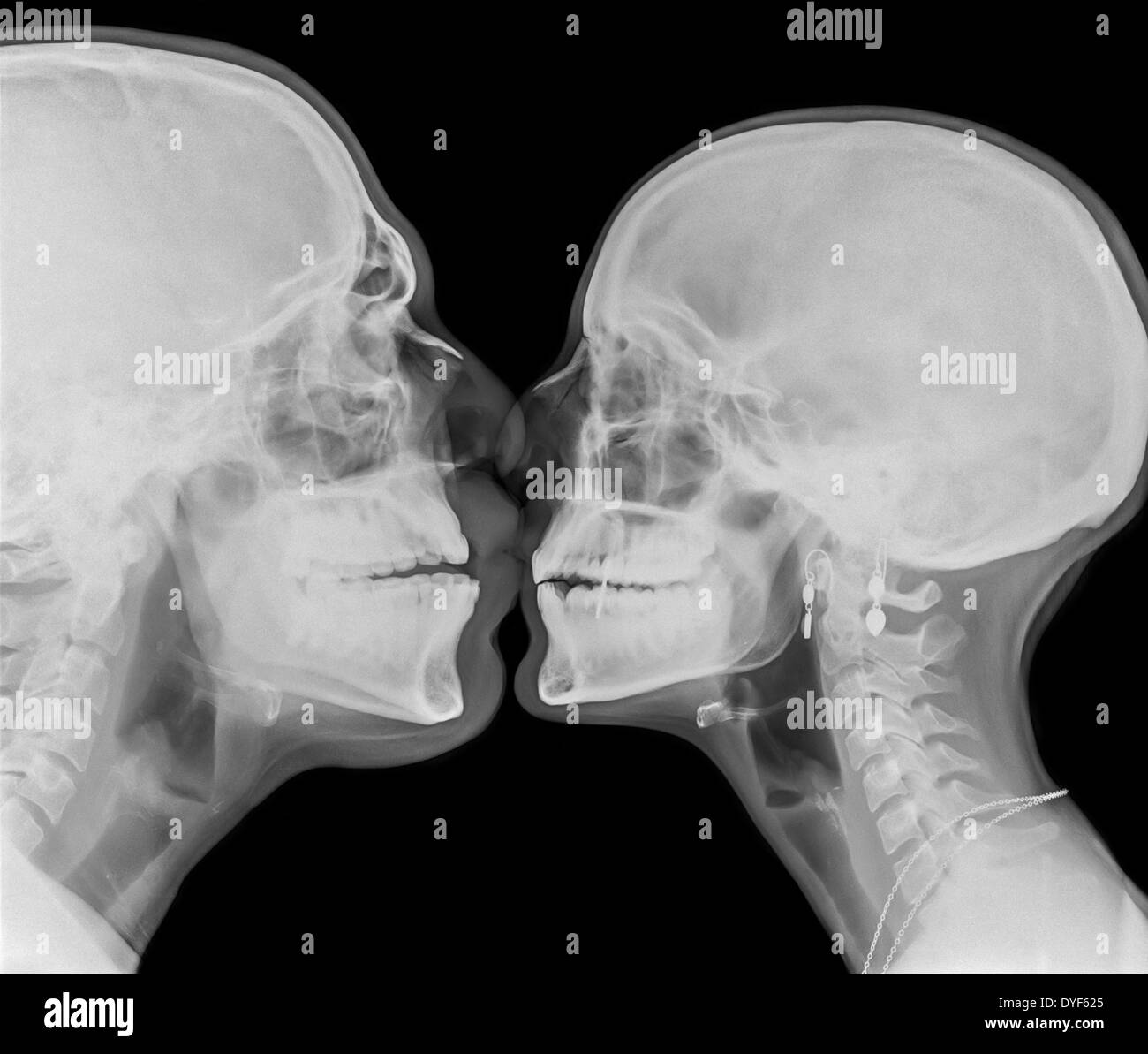 Kissing Couple. Two people kissing under x-ray Stock Photo