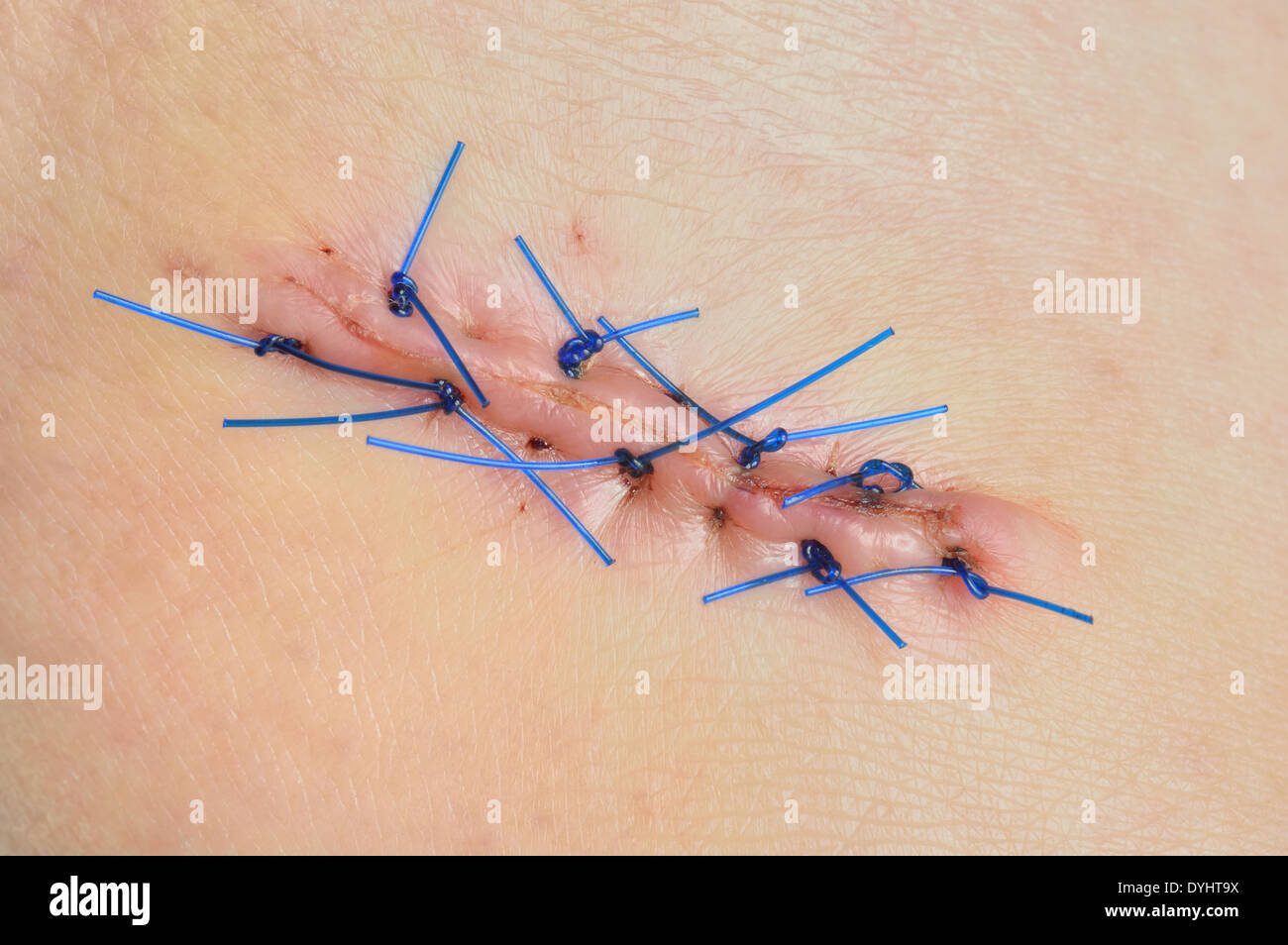 Close-up of stitched wound after skin biopsy on woman's leg. Skin nevus removed to be sent to a pathologist. Stock Photo