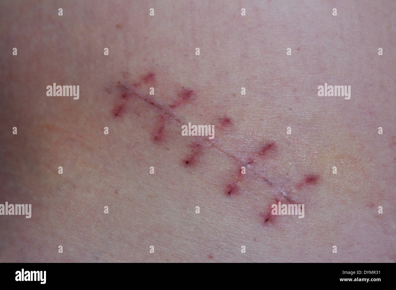 Scab scar hires stock photography and images Alamy