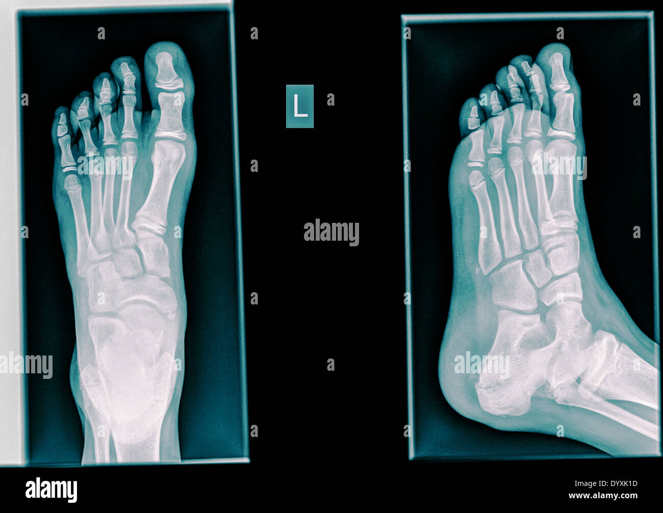 Healthy X-ray ofa foot of a 12 year old male Stock Photo