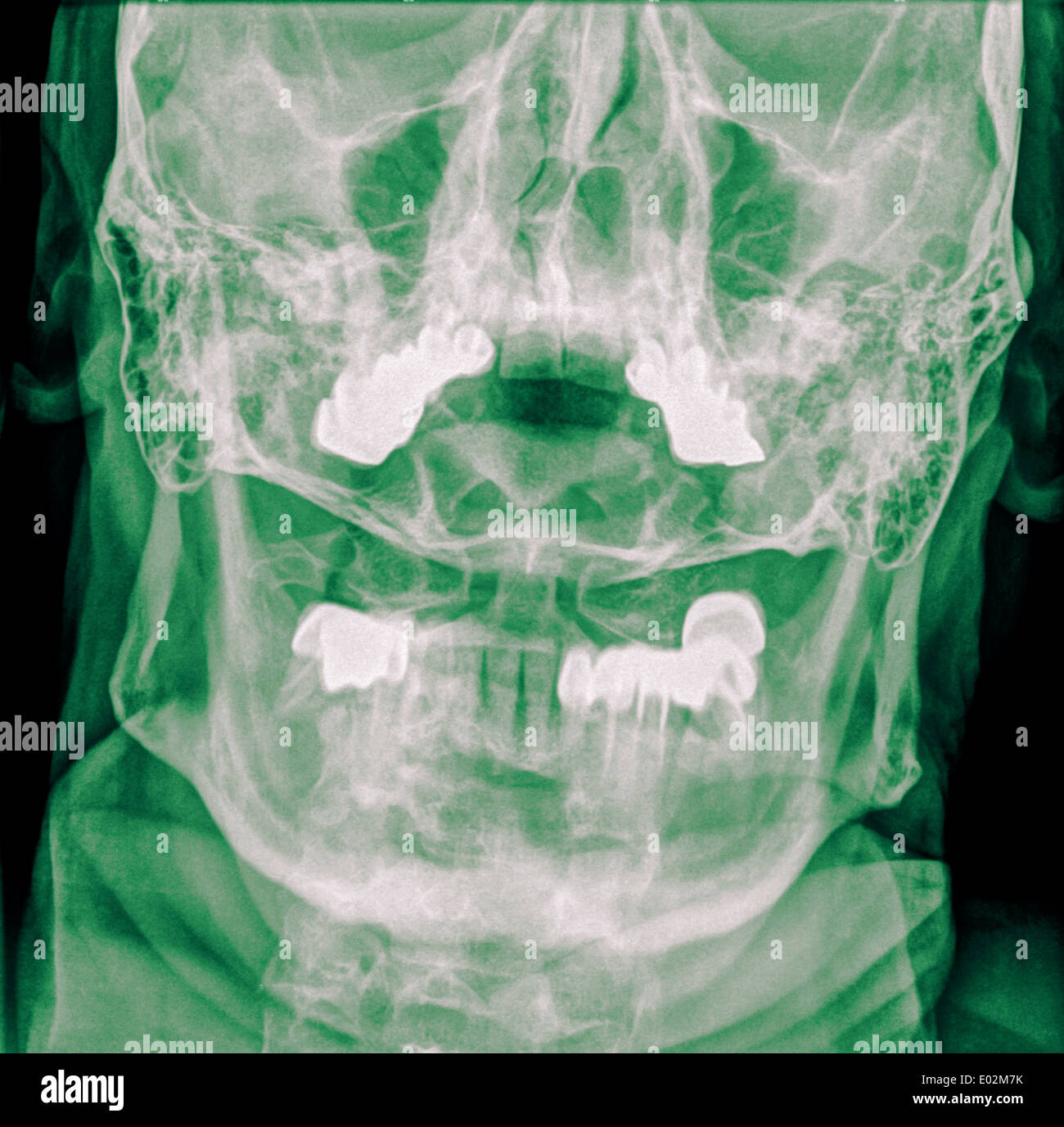 Cervical spine x-ray with a fractured Dens. A 50 year old male patient Front View Stock Photo