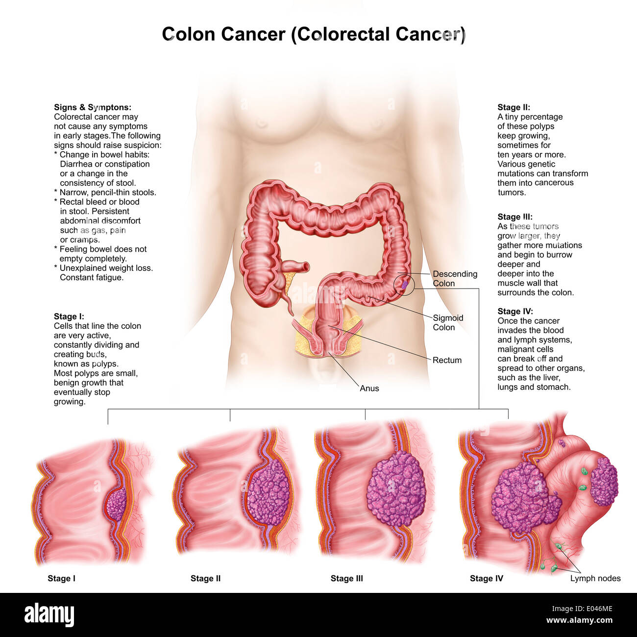 Medical illustration depicting the different stages of colon cancer. Stock Photo