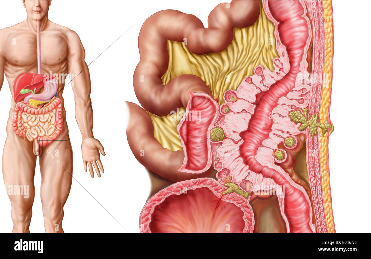 Illustration of diverticulosis in the colon. Stock Photo