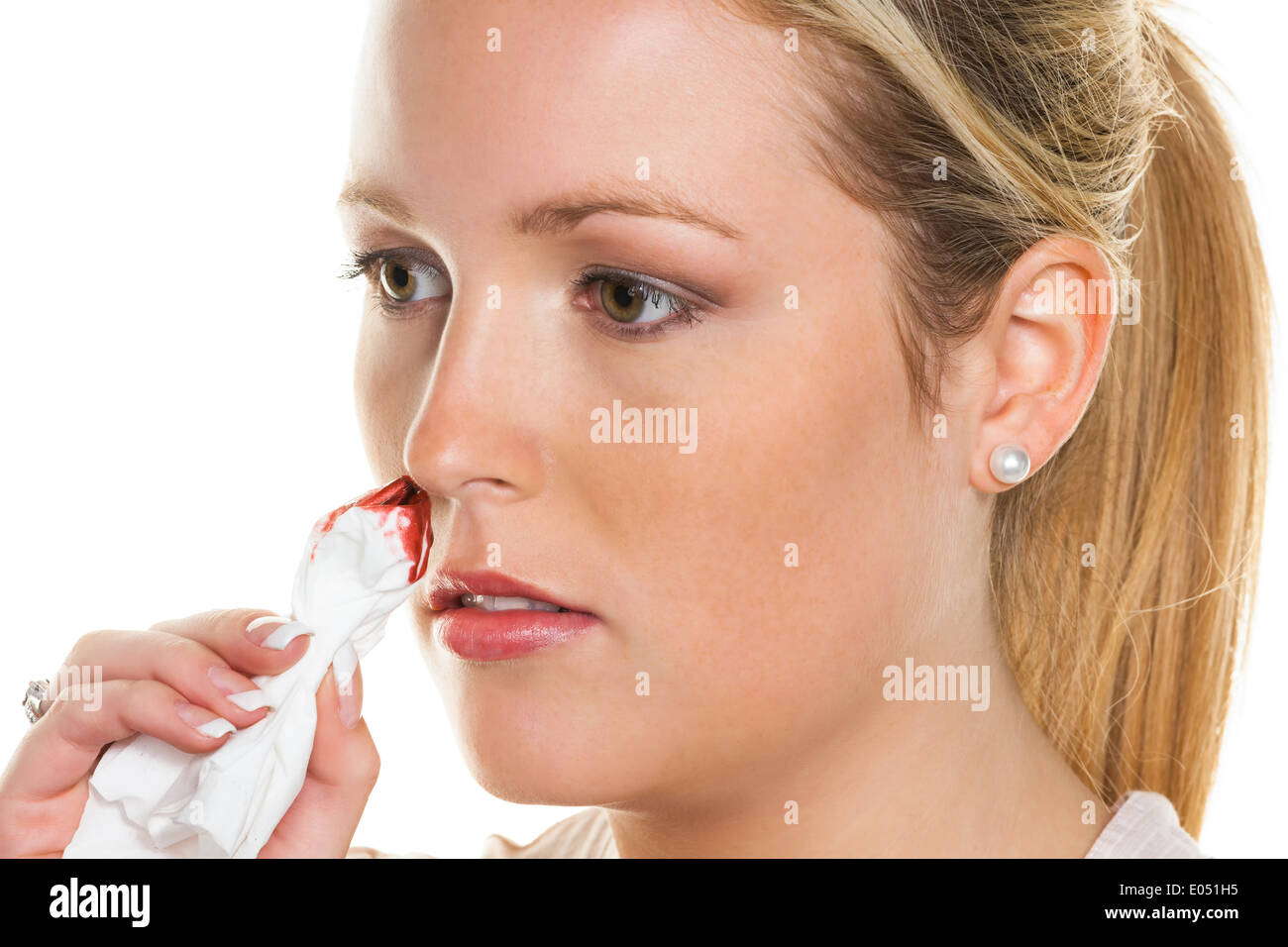 A young woman bleeds from her nose. Stops noses bleed with a handkerchief., Eine junge Frau blutet aus ihrer Nase. Stoppt Nasen Stock Photo