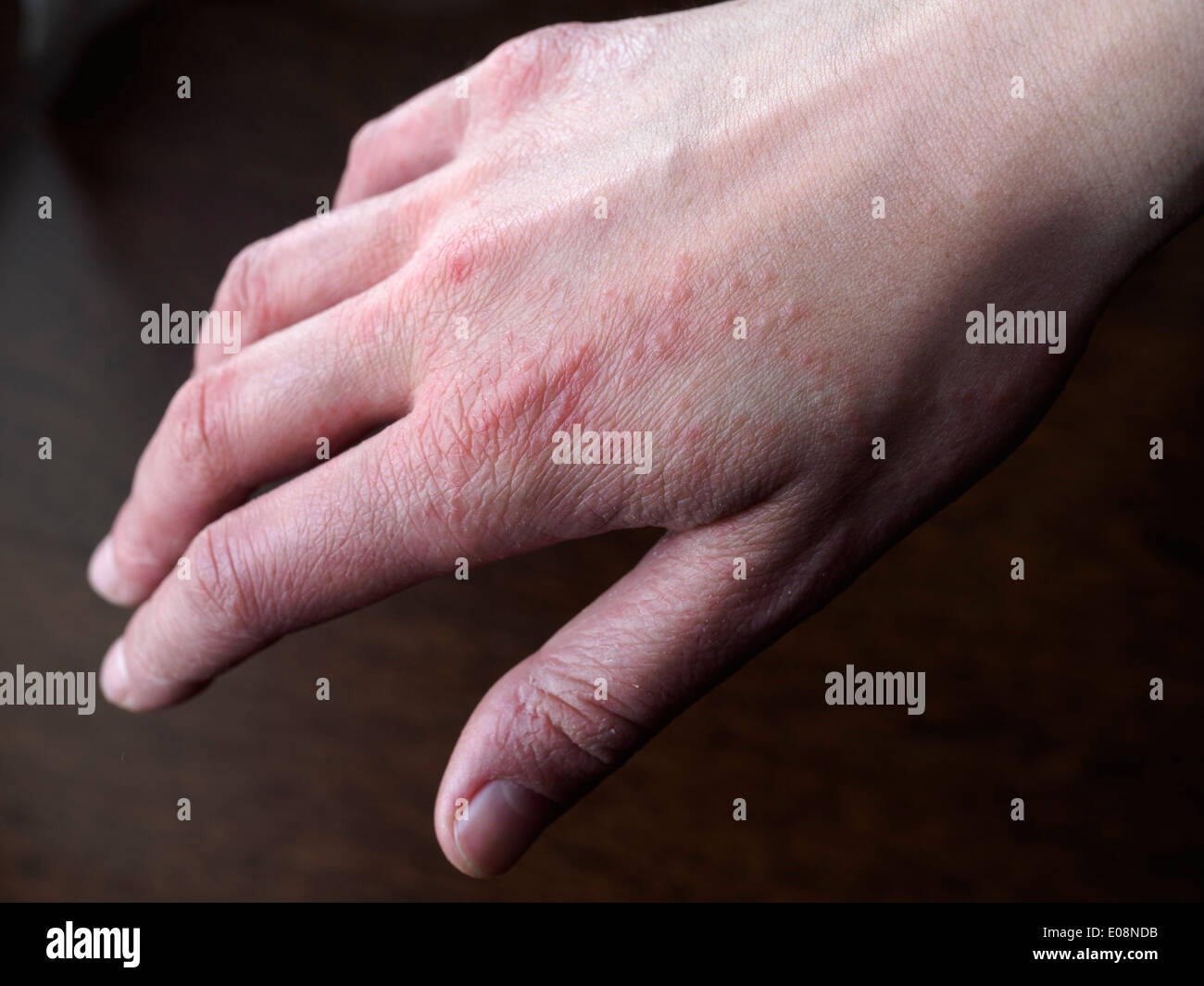 Hand with eczema Stock Photo