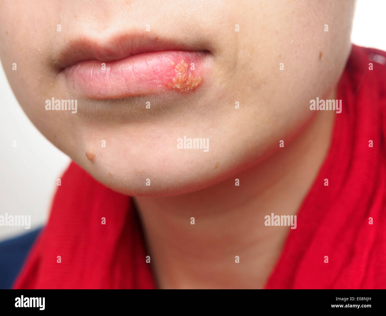 Young woman with herpes simplex infection on lower lip Stock Photo