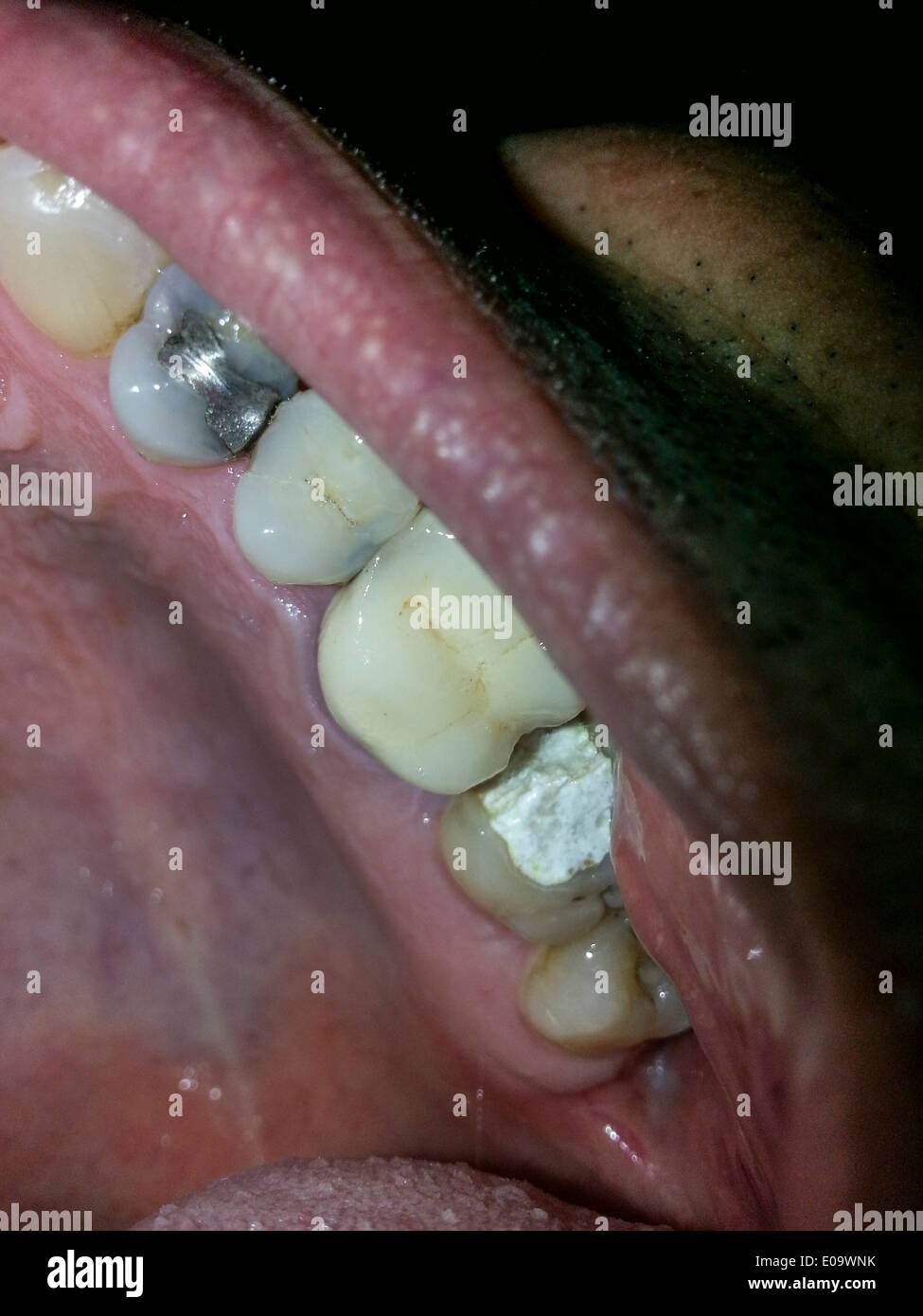 Close up of a tooth with a temporary filling Stock Photo