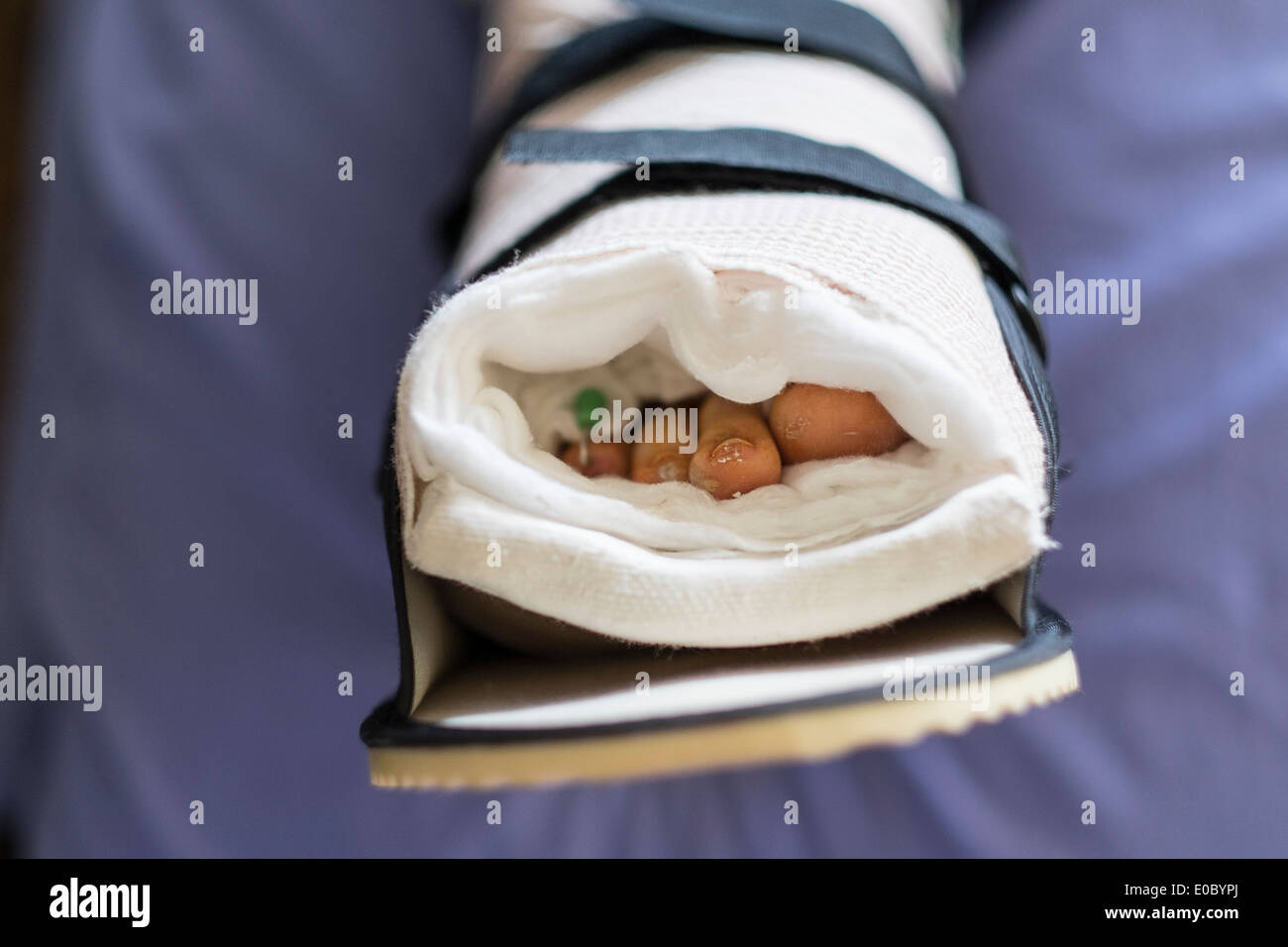 The foot of a Caucasian woman in her 40s who suffers with Rheumatoid Arthritis, who underwent surgery on her toes that morning. Wichita, Kansas, USA Stock Photo