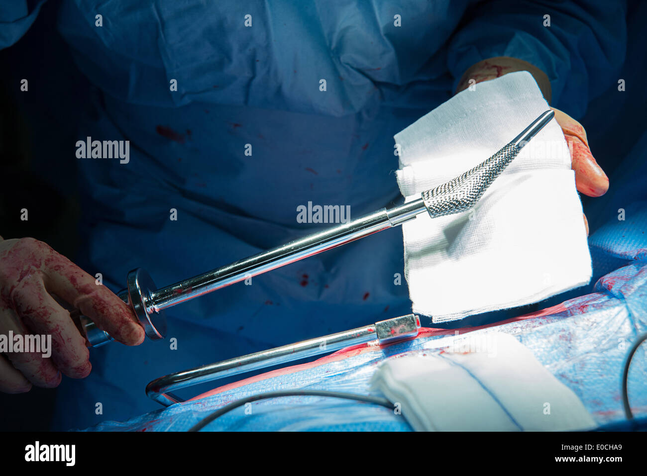 Hip prosthesis, surgery Stock Photo