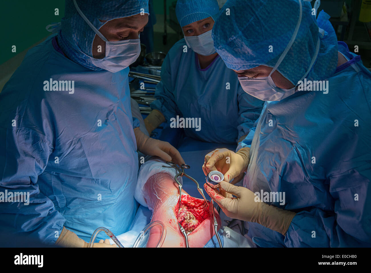 Hip prosthesis, surgery Stock Photo