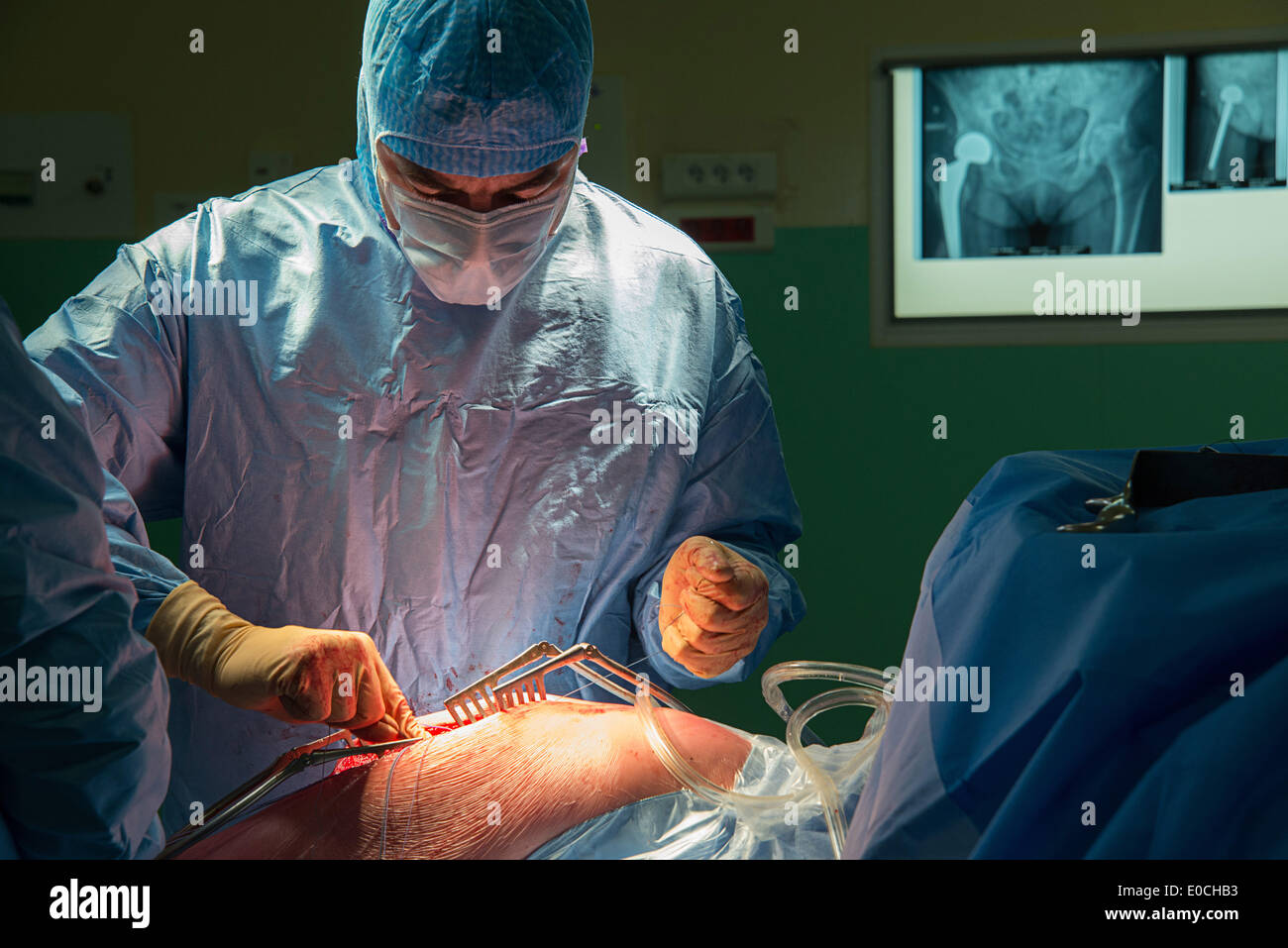 Hip prosthesis, surgery Stock Photo