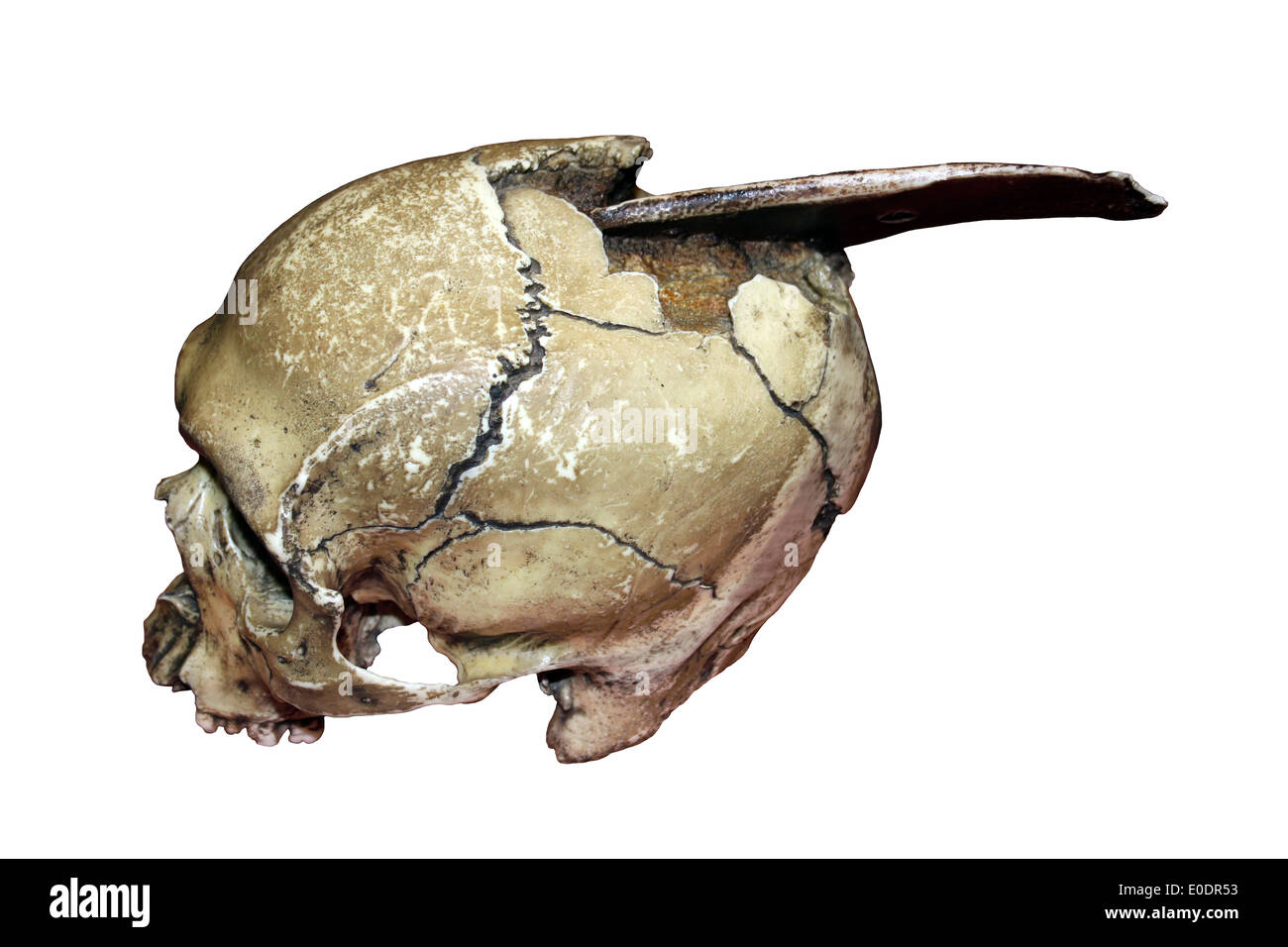 Reconstruction Of A Conquistador Male Skull With 'Boarding Ax' Embedded In Cranium Stock Photo