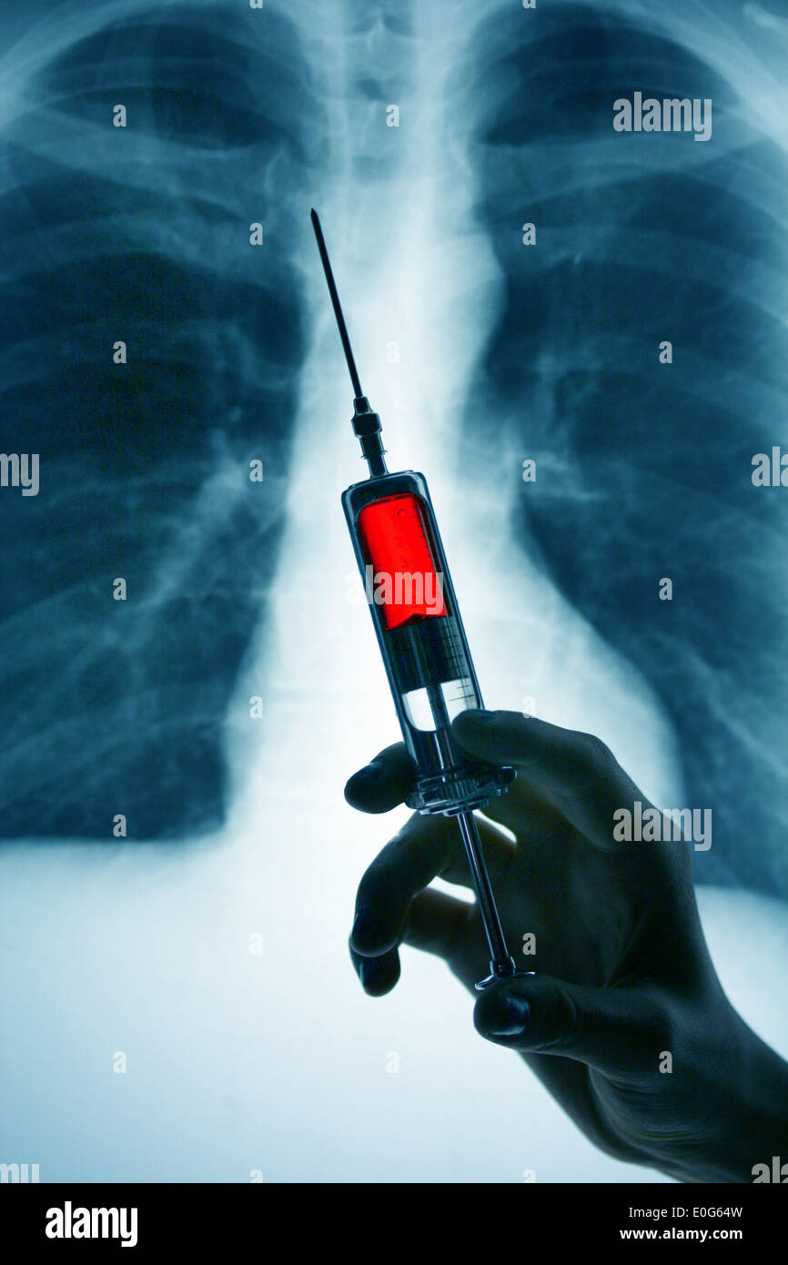 Lung X-ray examination with syringe Stock Photo
