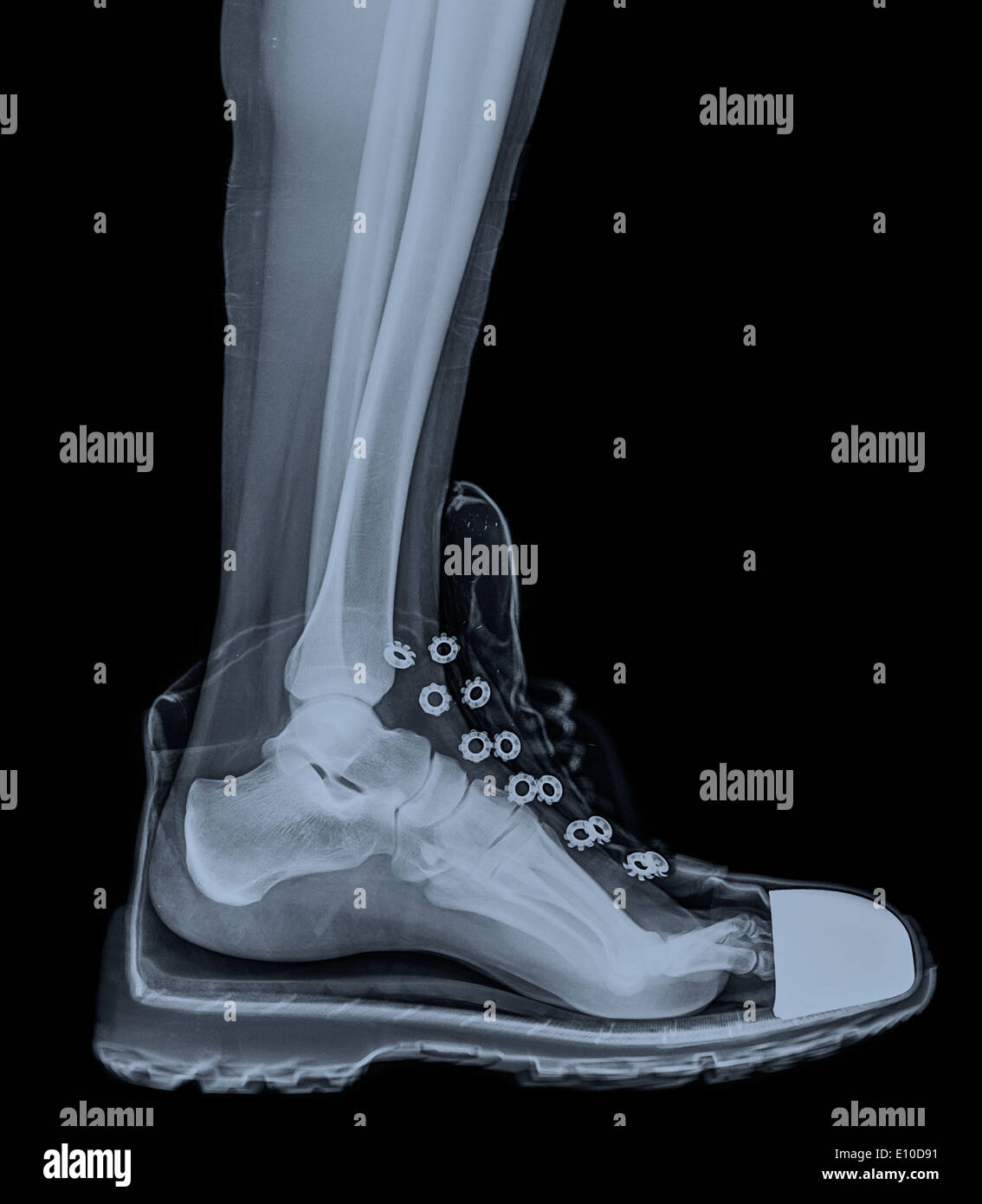 X-Ray of a foot and ankle in a running shoe Stock Photo - Alamy