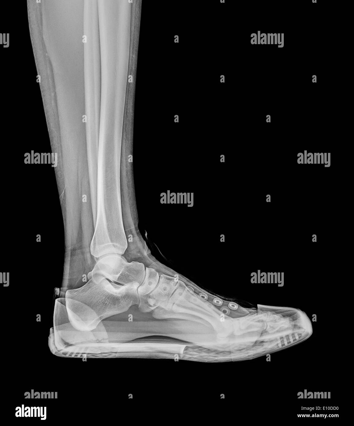 Foot xray and shoe hi-res stock photography and images - Alamy