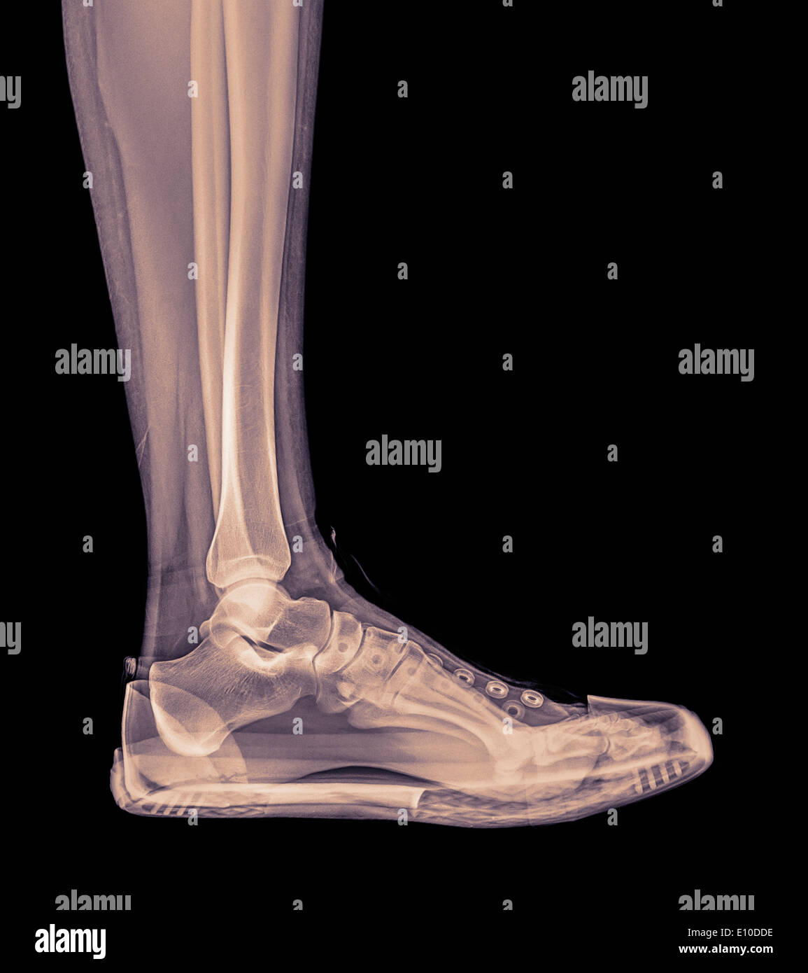 XRay of a foot and ankle in a trainer Stock Photo Alamy